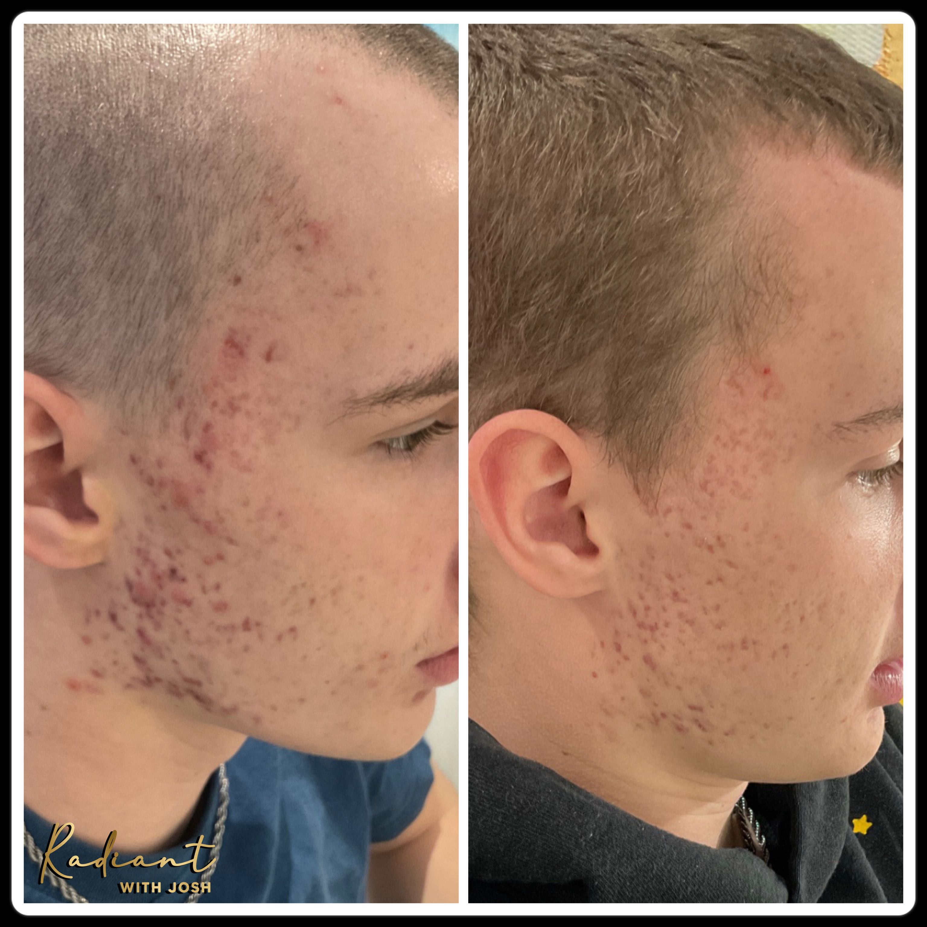 ADVATx® & SylfirmX® result