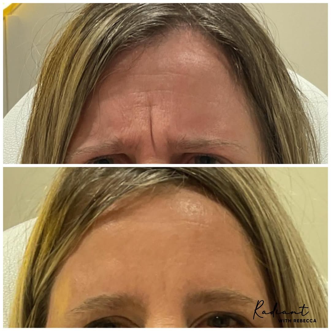Forehead Smoothing result
