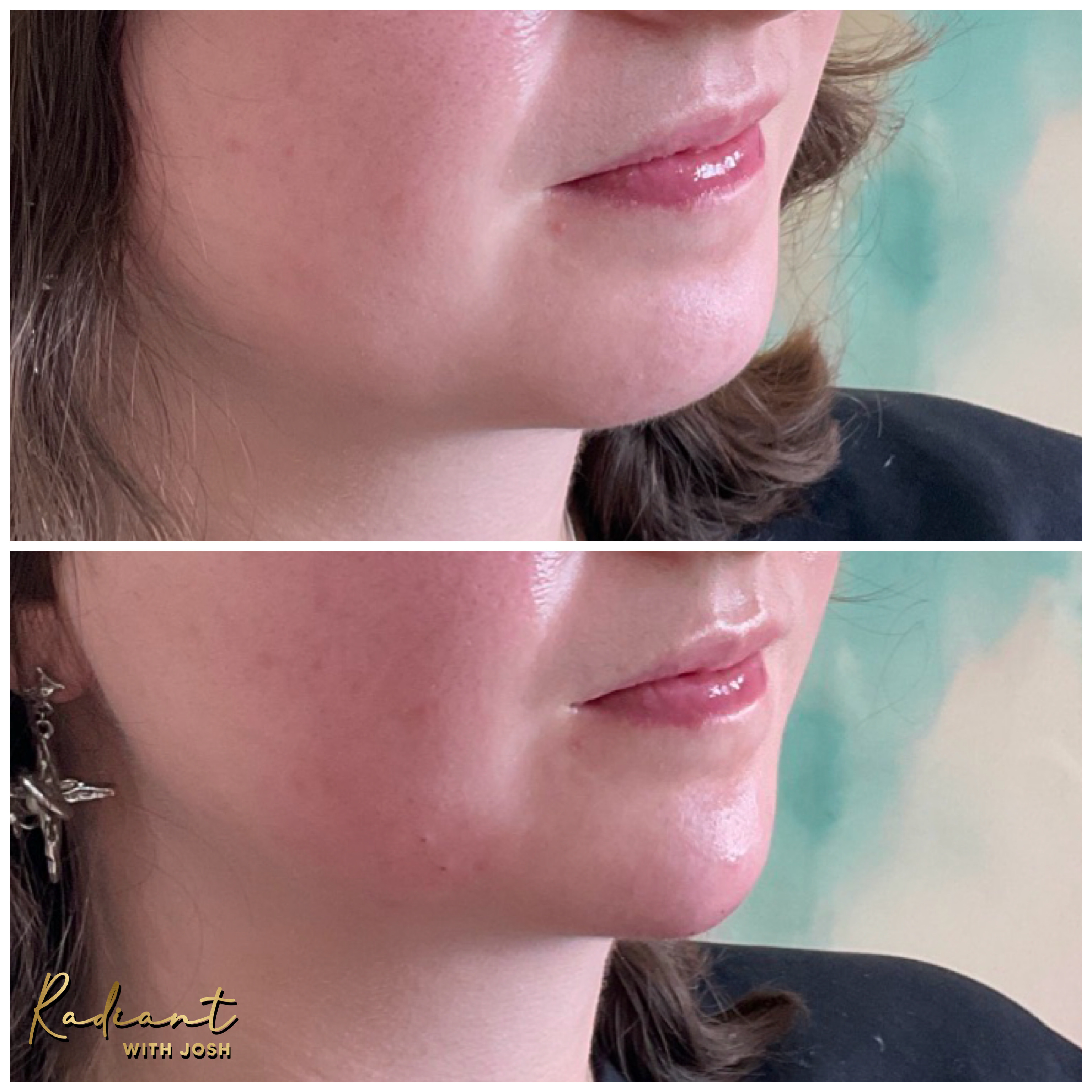 Chin Filler result