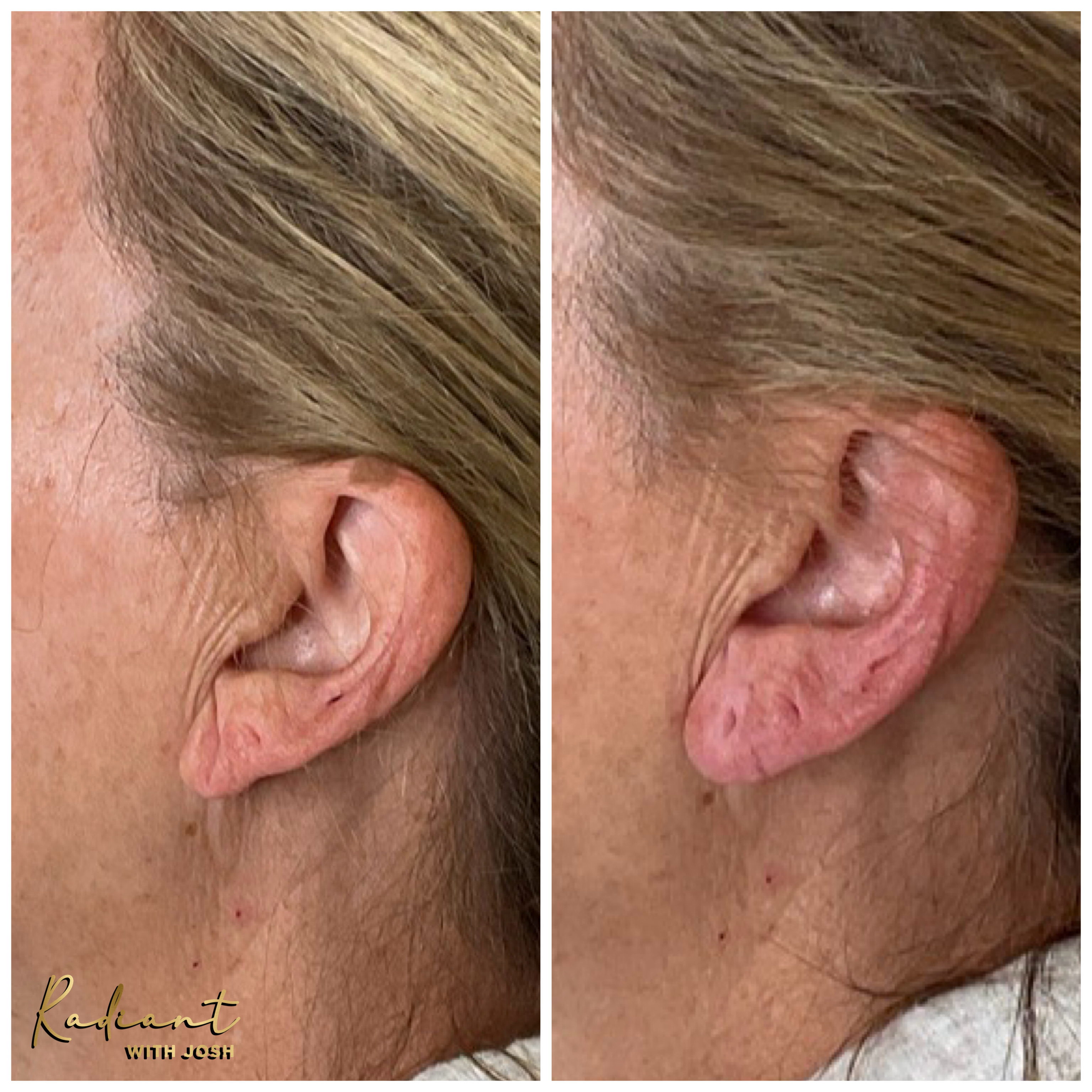 Ear Lobe Filler result