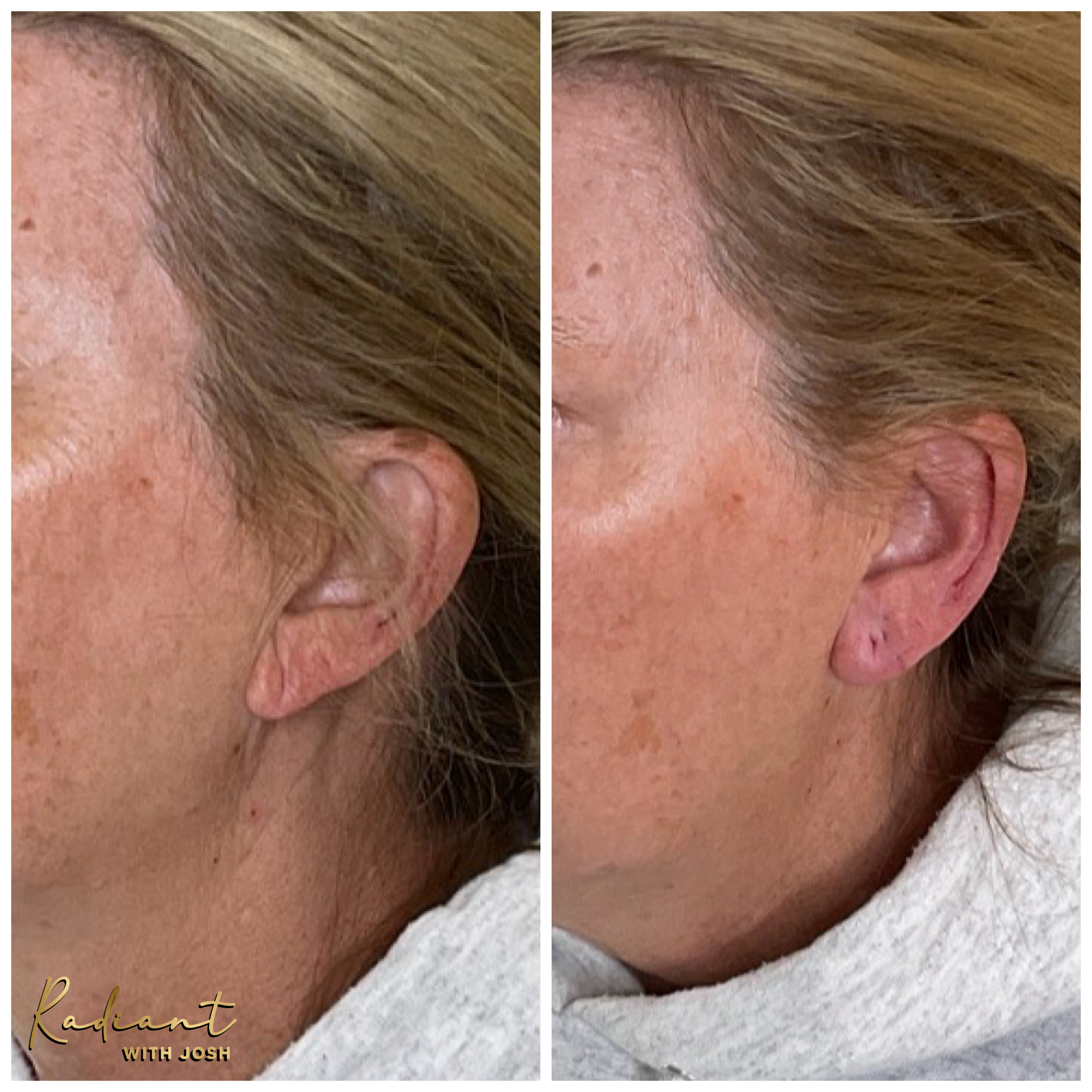 Ear Lobe Filler result