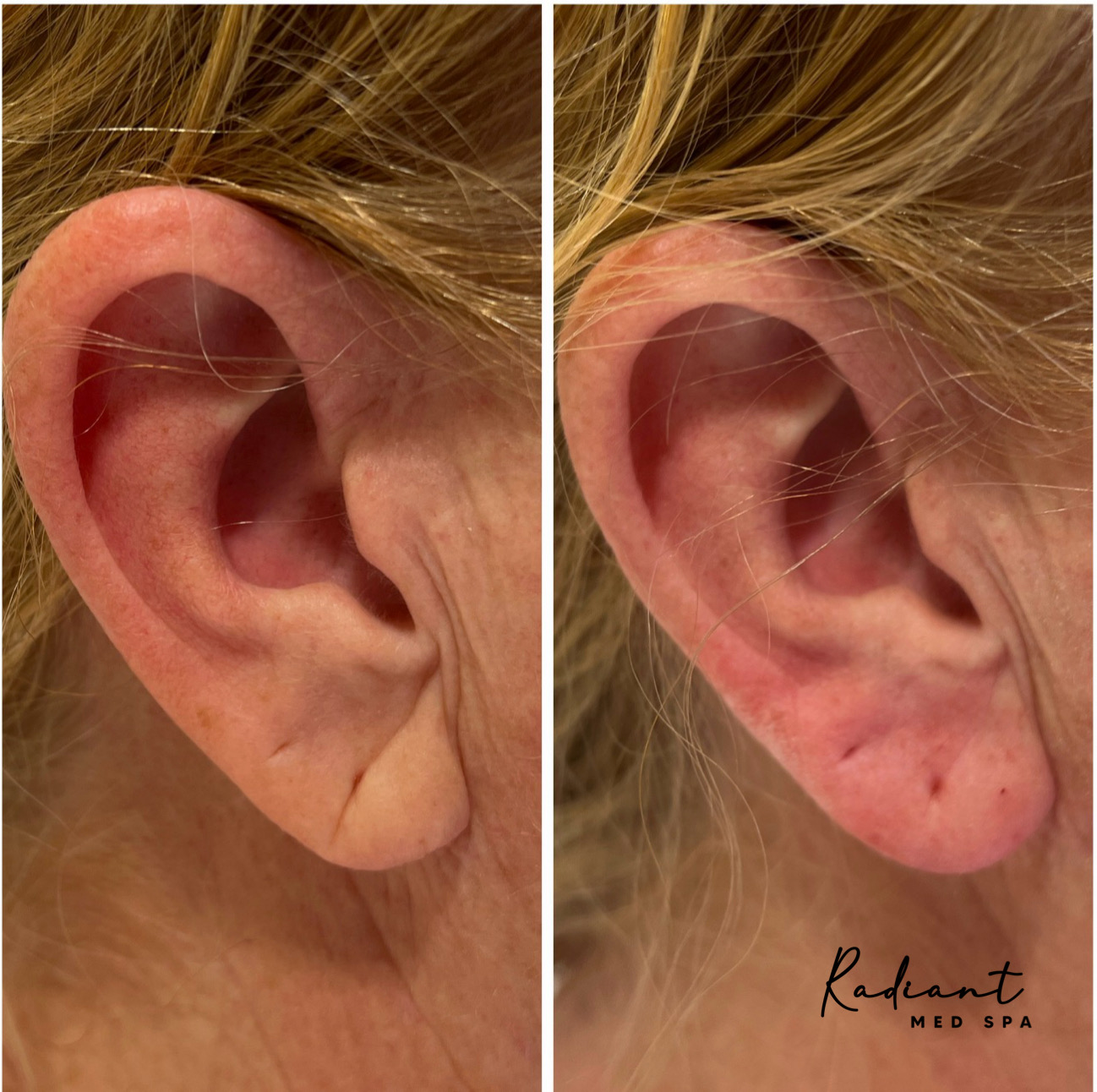 Ear Lobe Filler result
