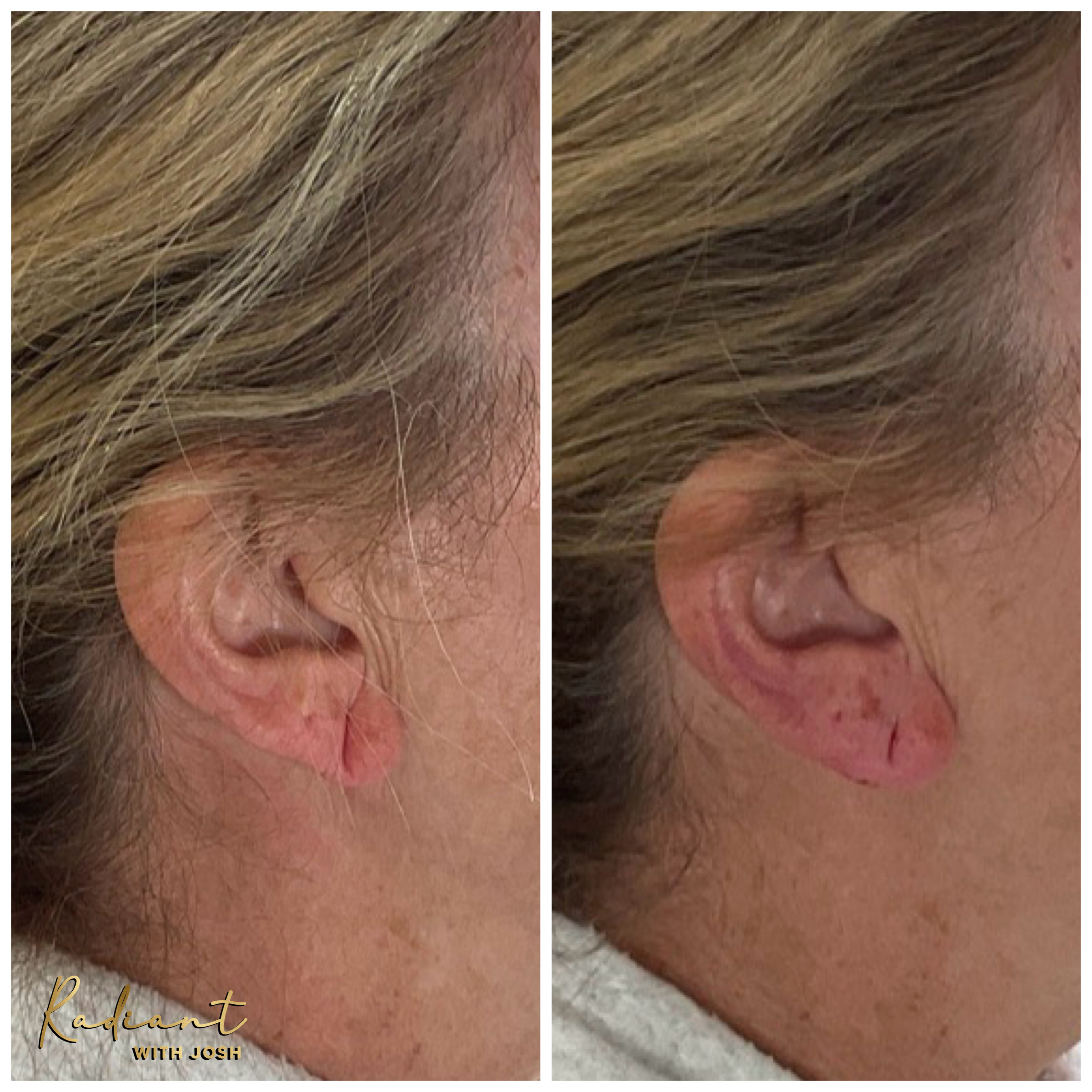 Ear Lobe Filler result