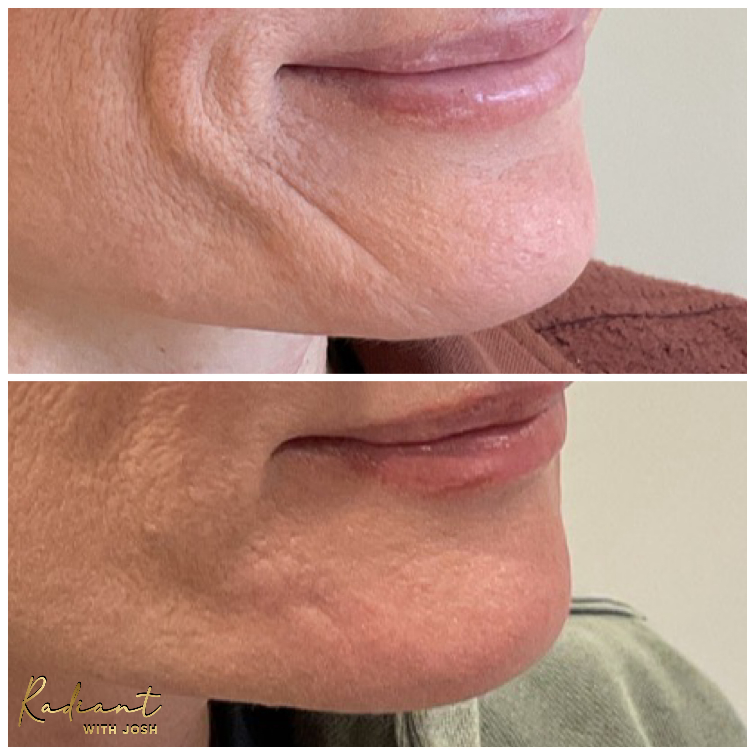 Lower Face Filler result