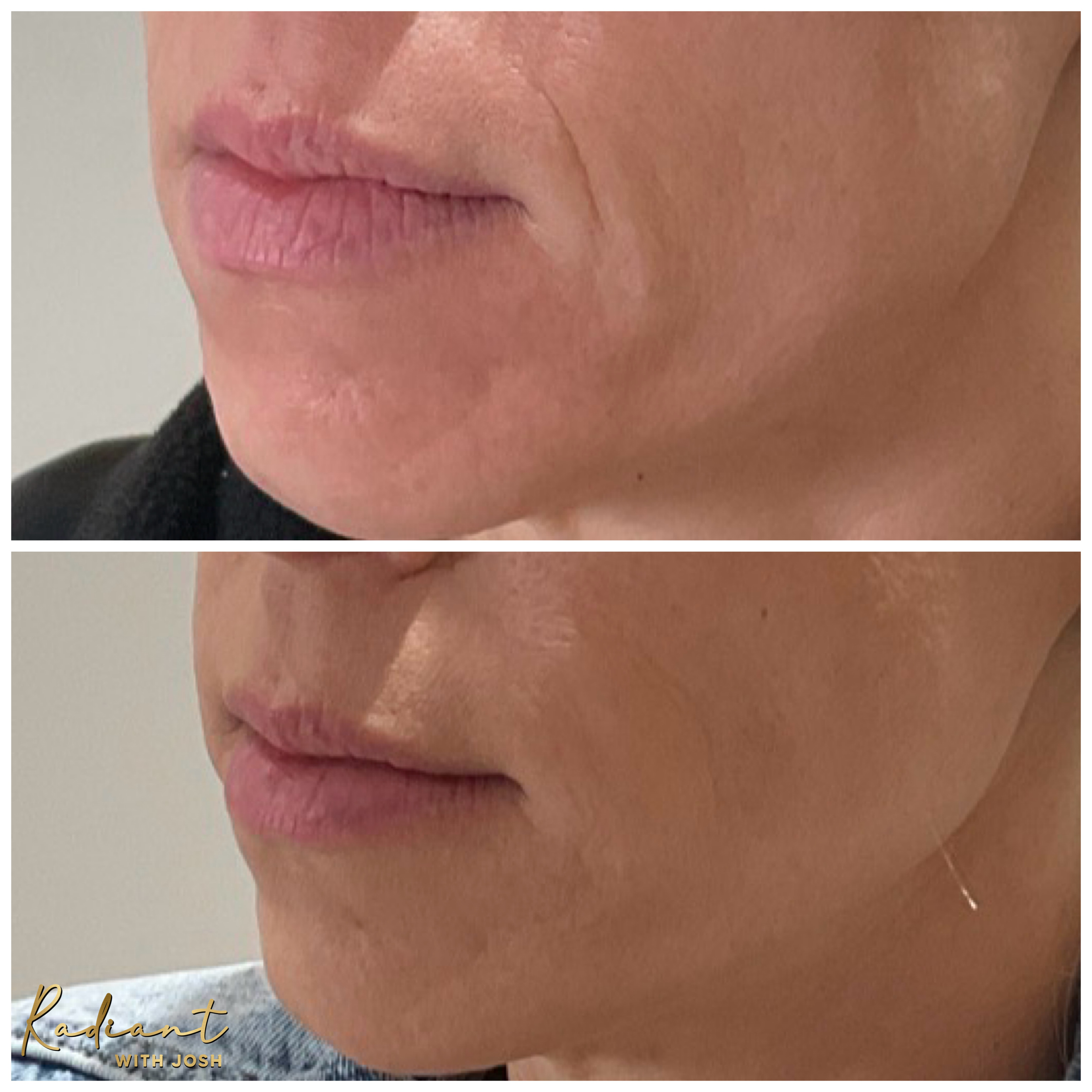 Lower Face Filler result