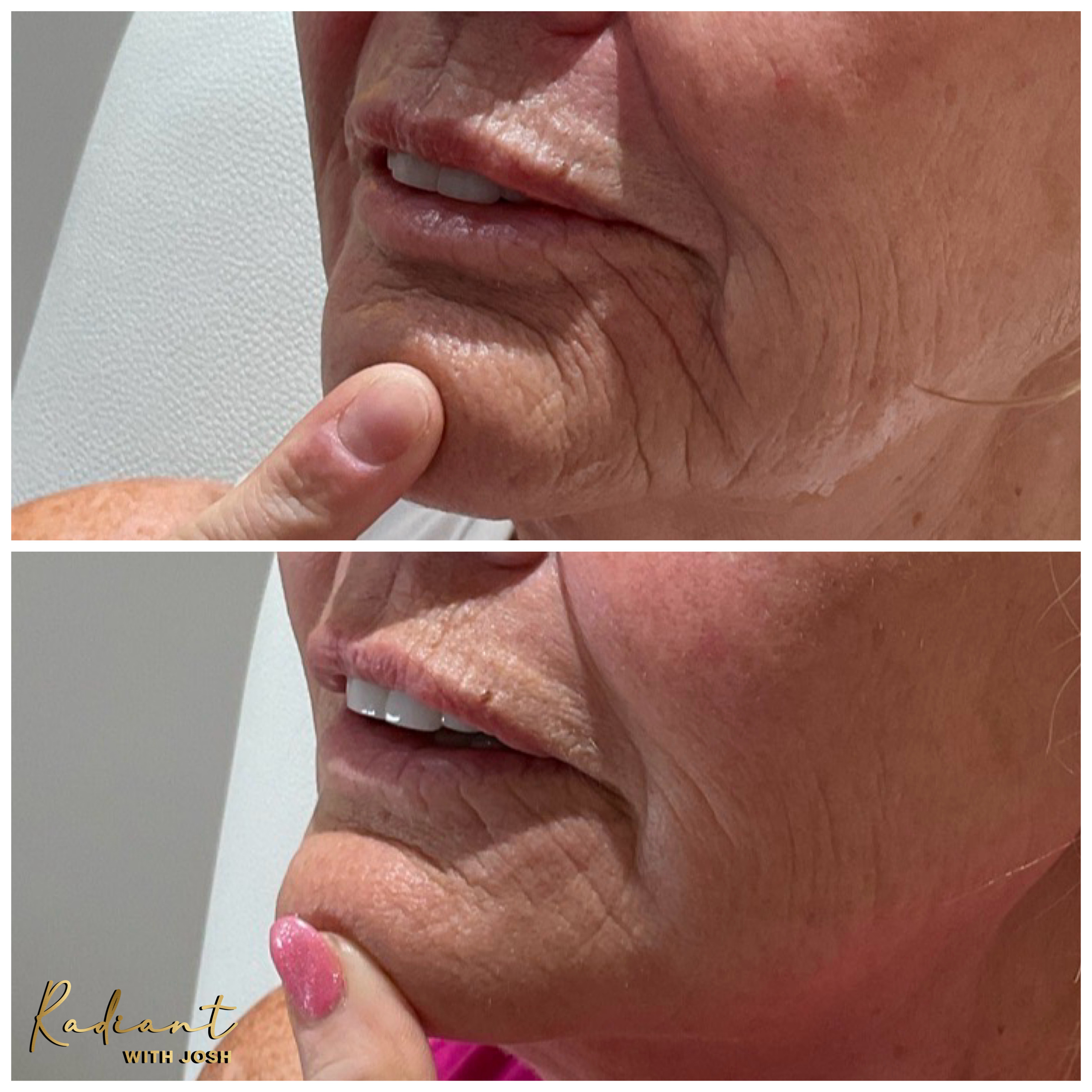 Lip & Perioral Filler result