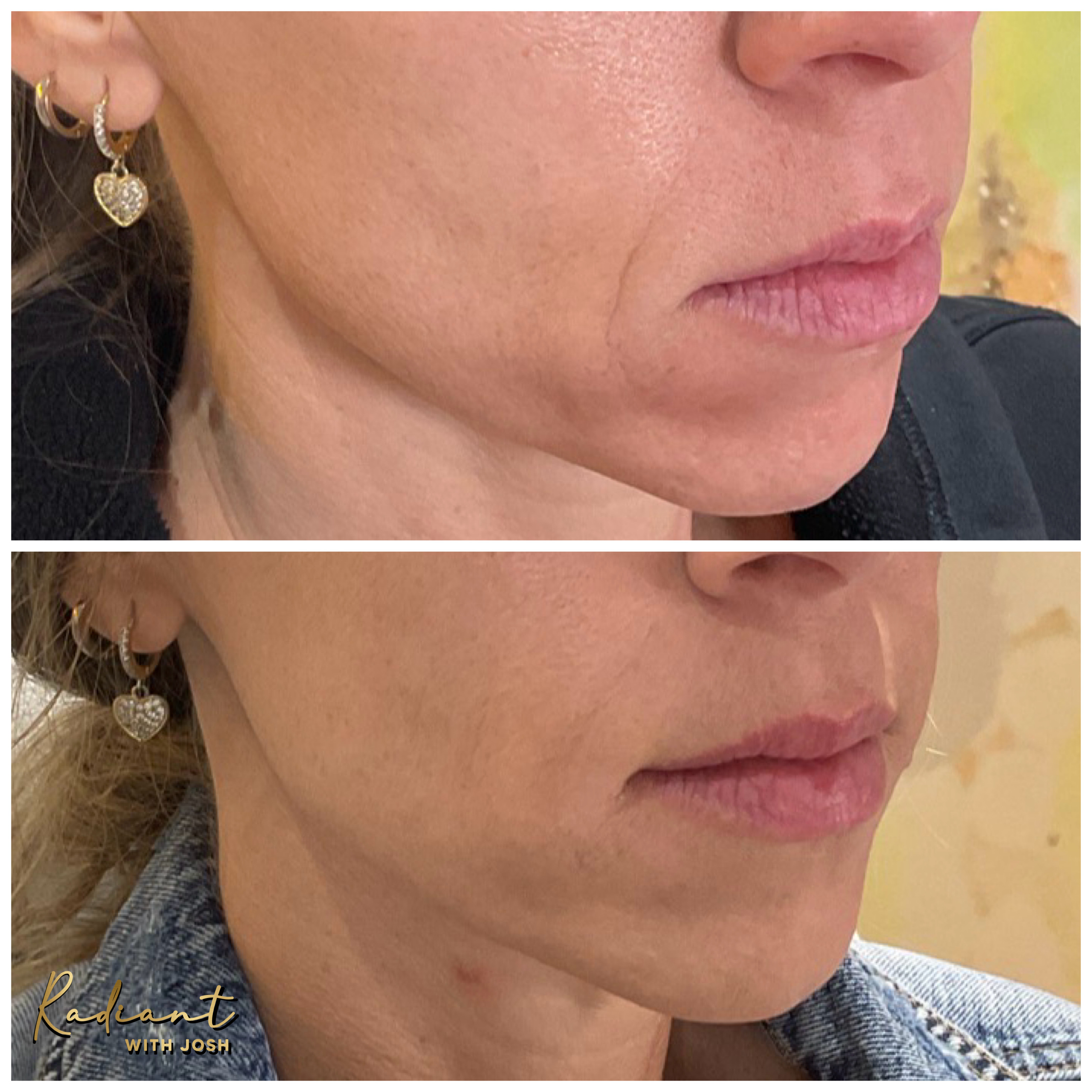 Lower Face Filler result