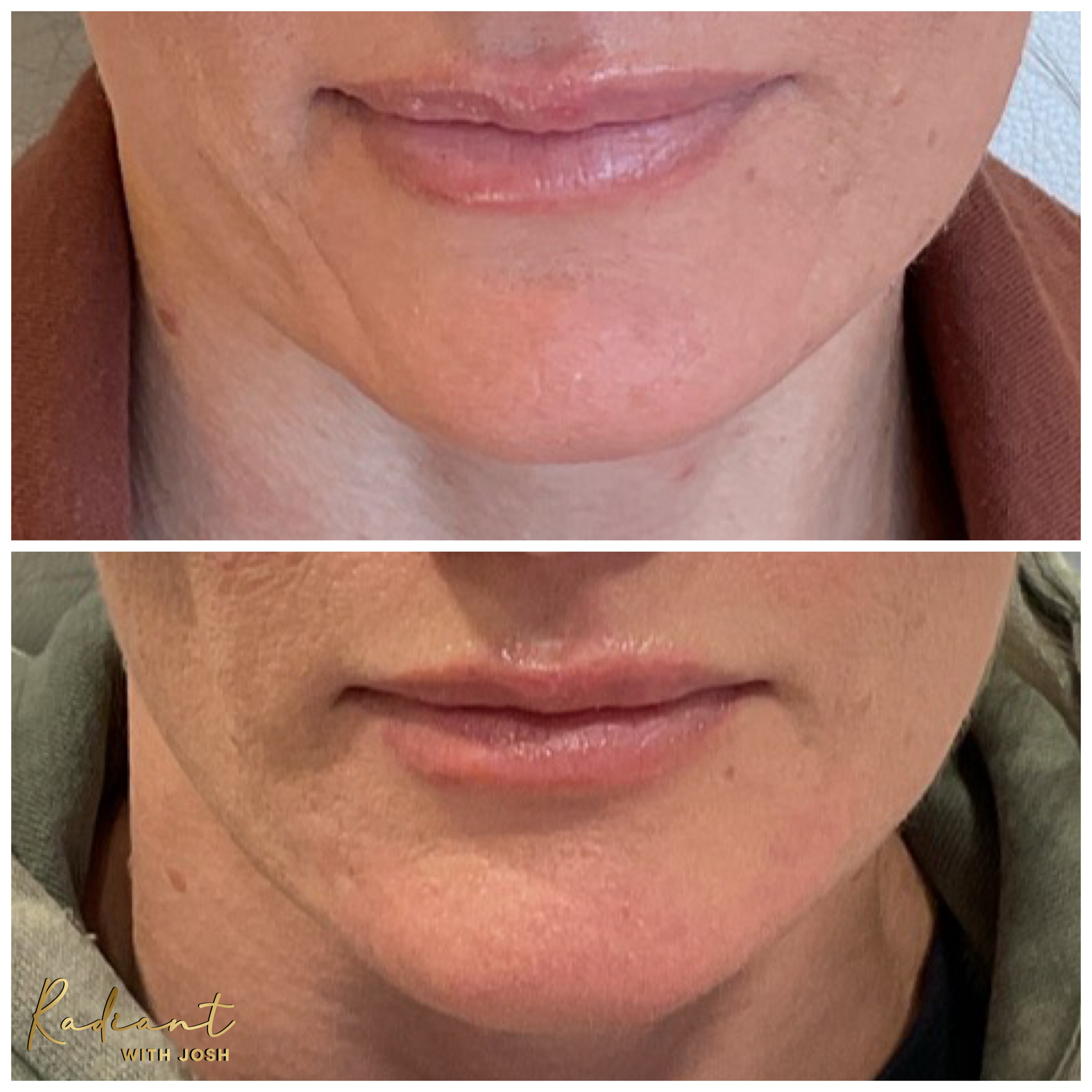 Lower Face Filler result