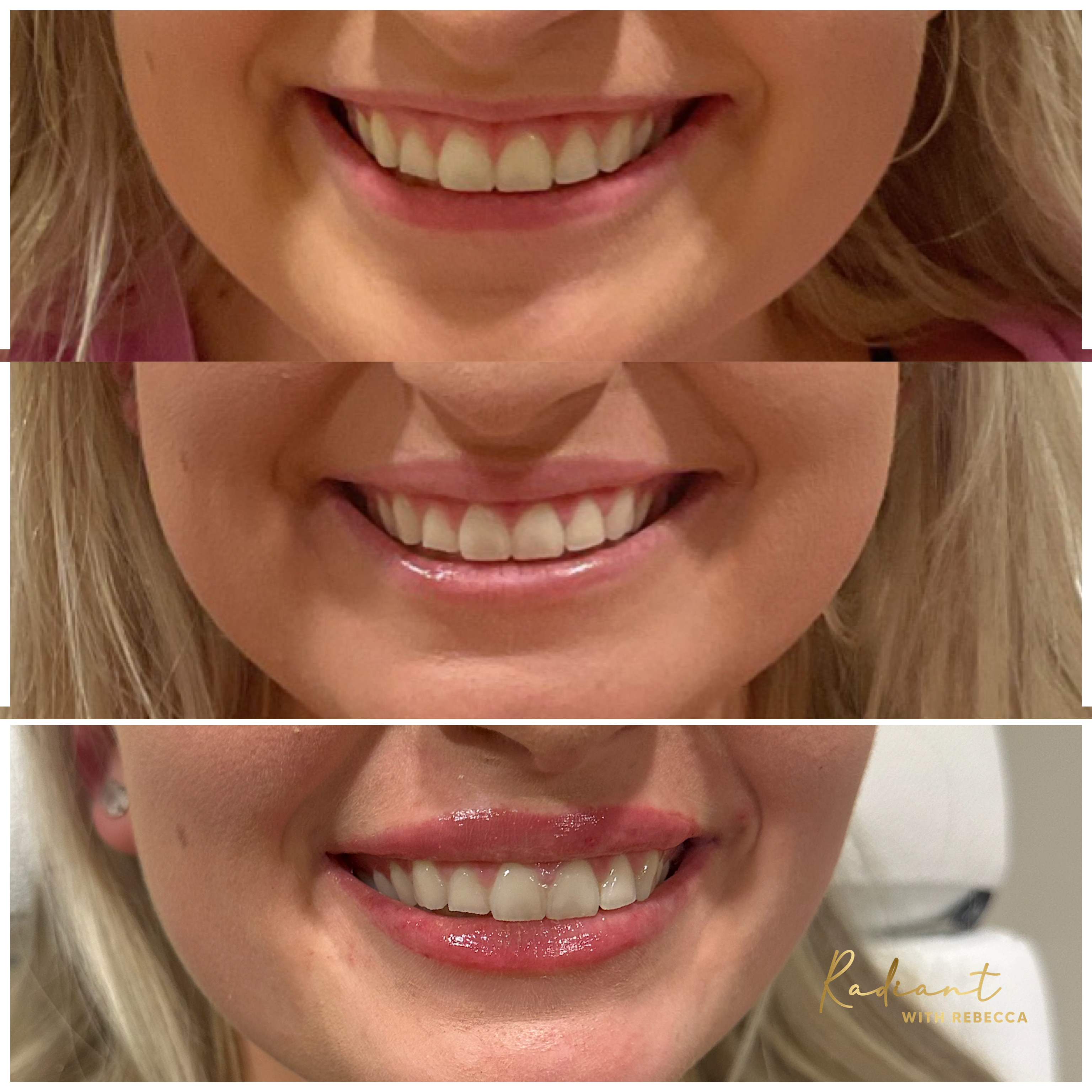 Lip Flip & Lip Filler result