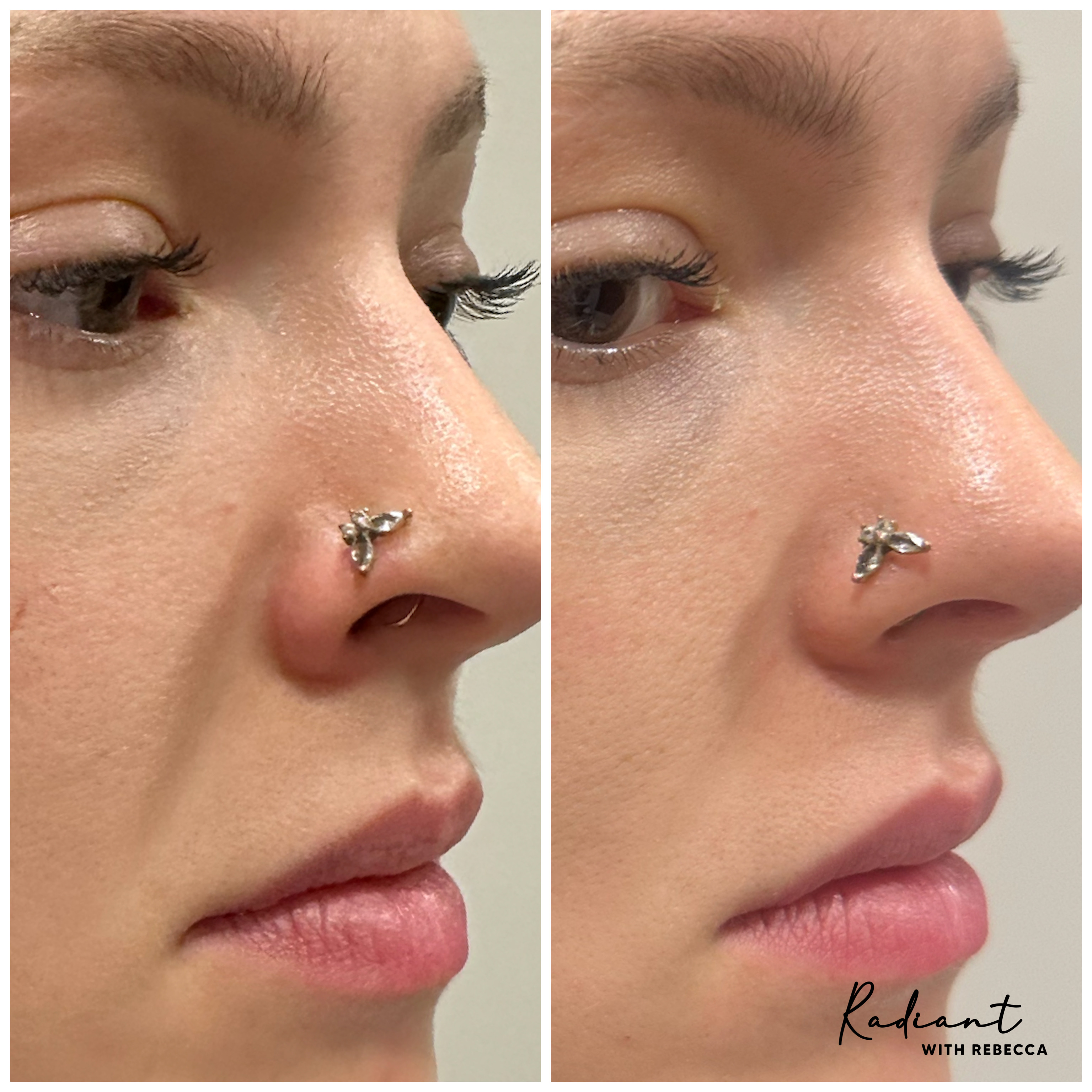 Piriform Filler result