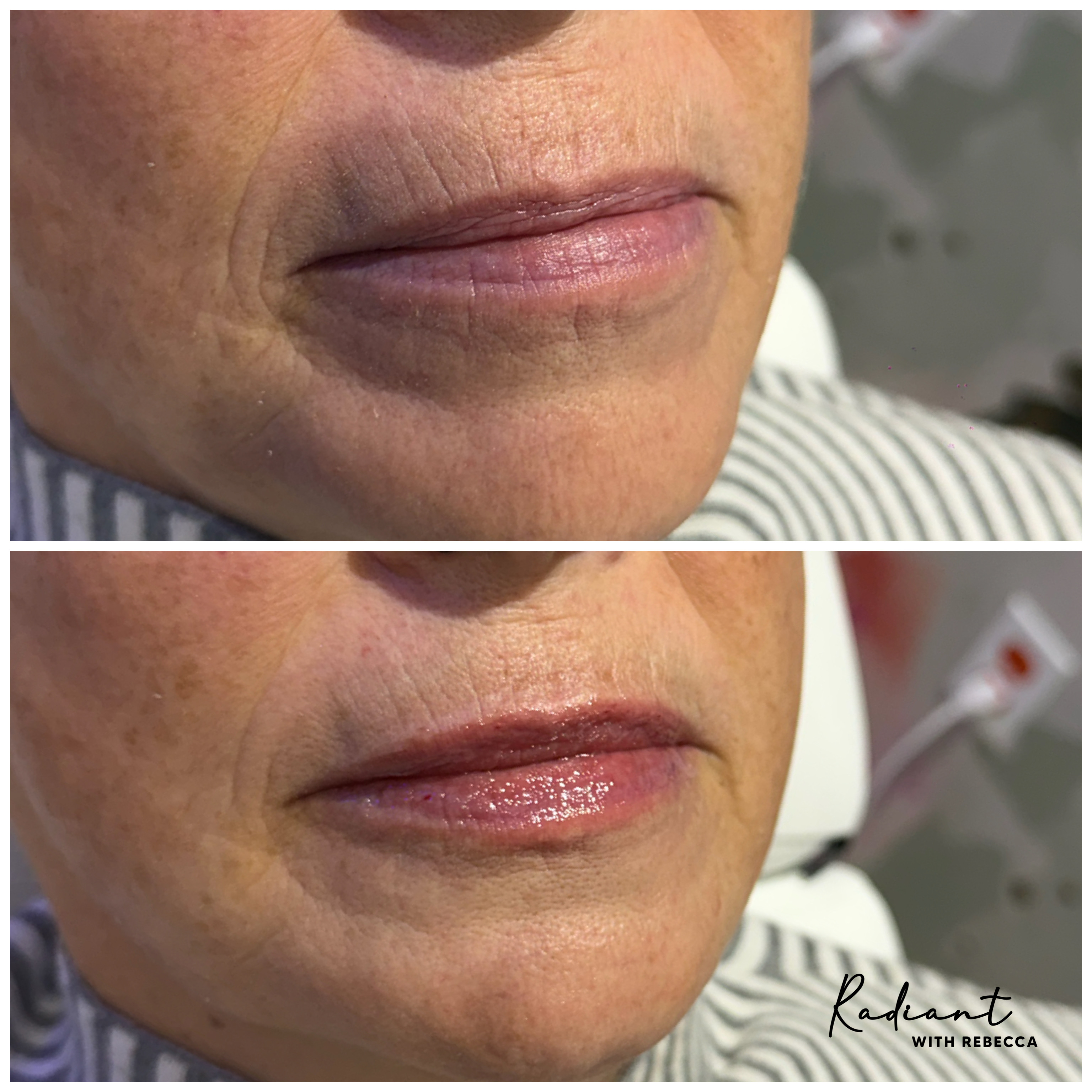 Lip Filler result