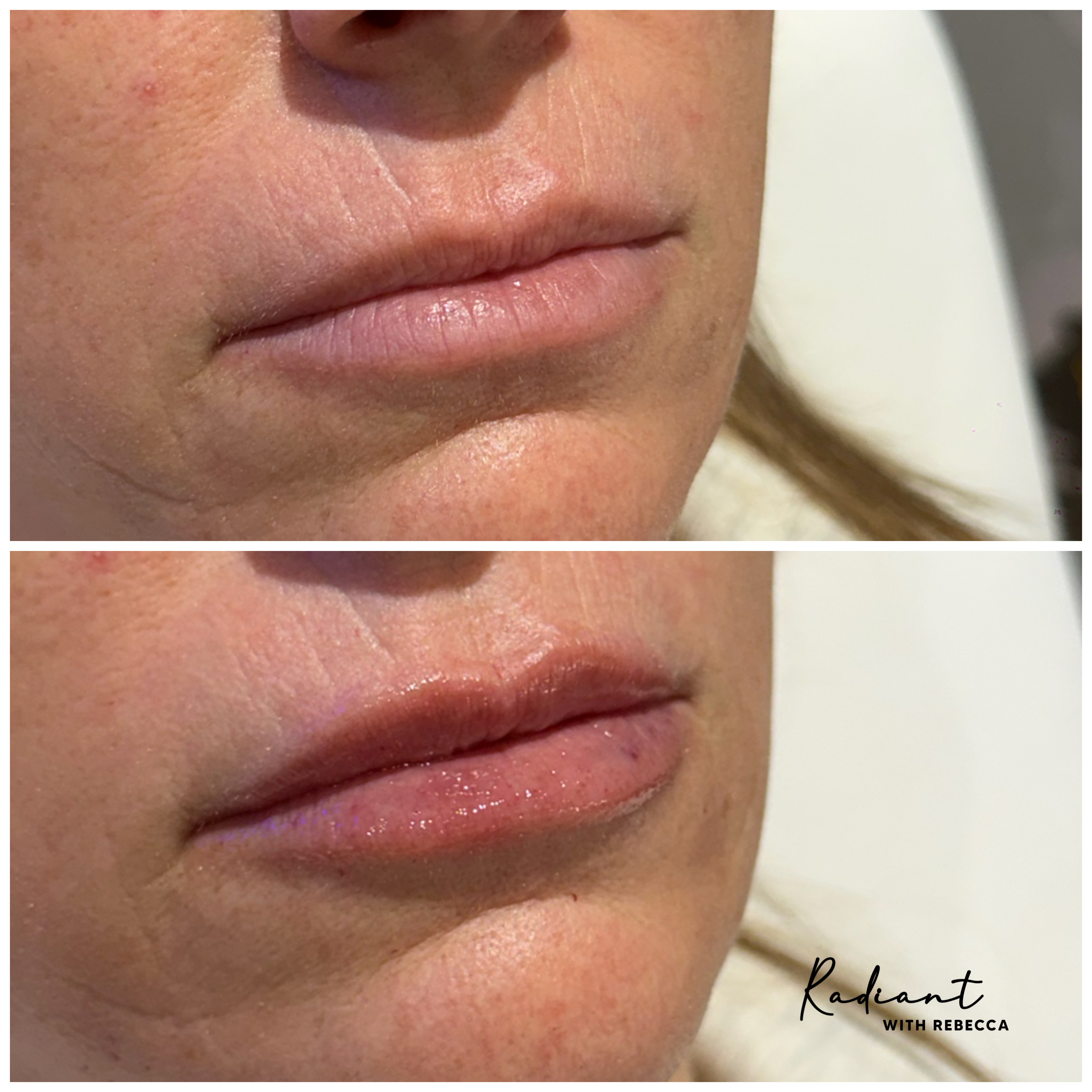 Lip Filler result