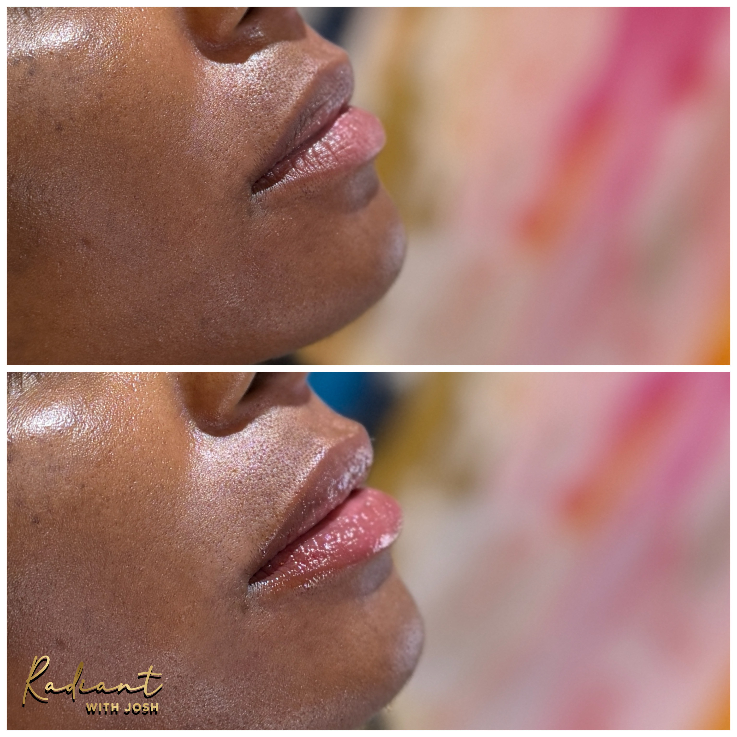 Lip Filler result