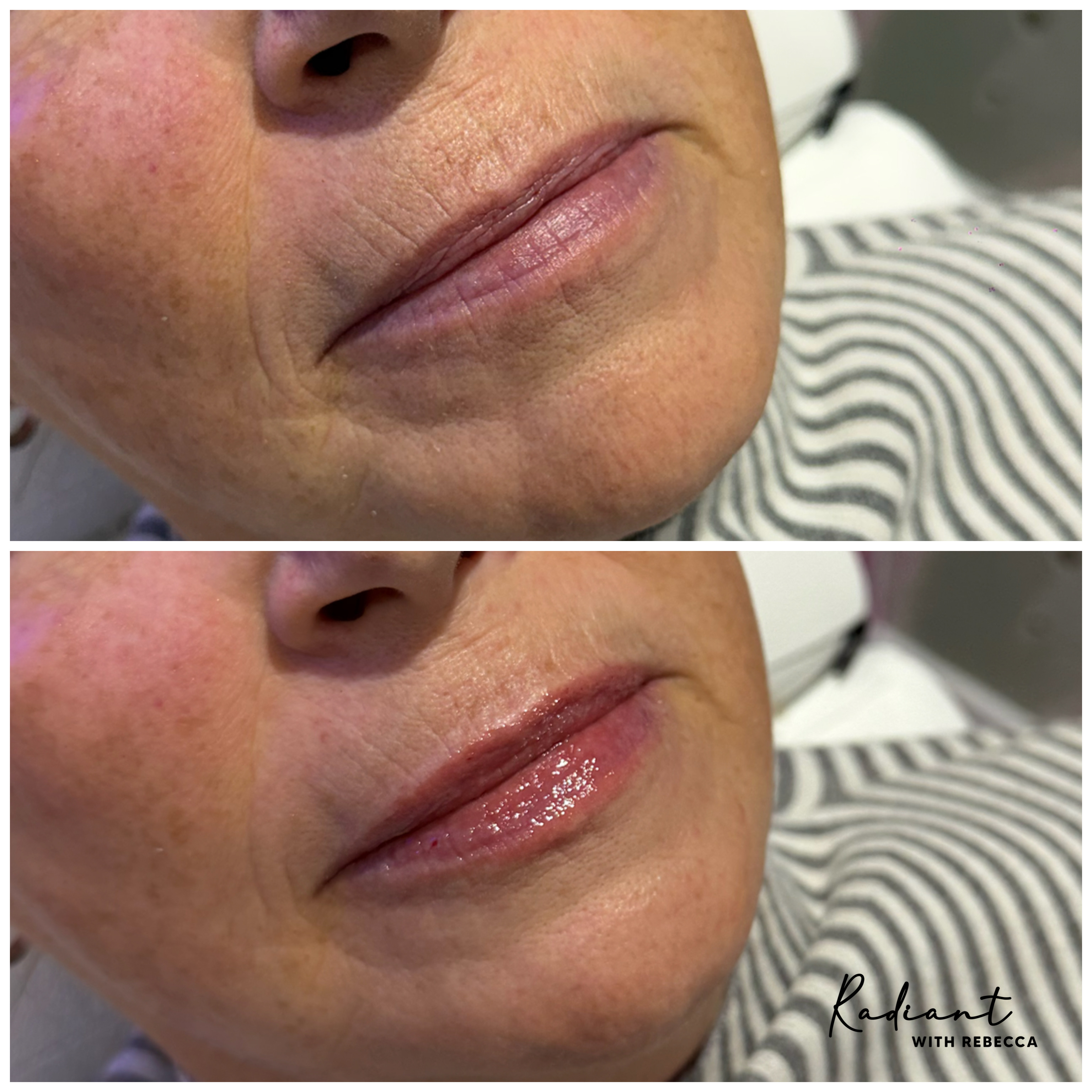 Lip Filler result