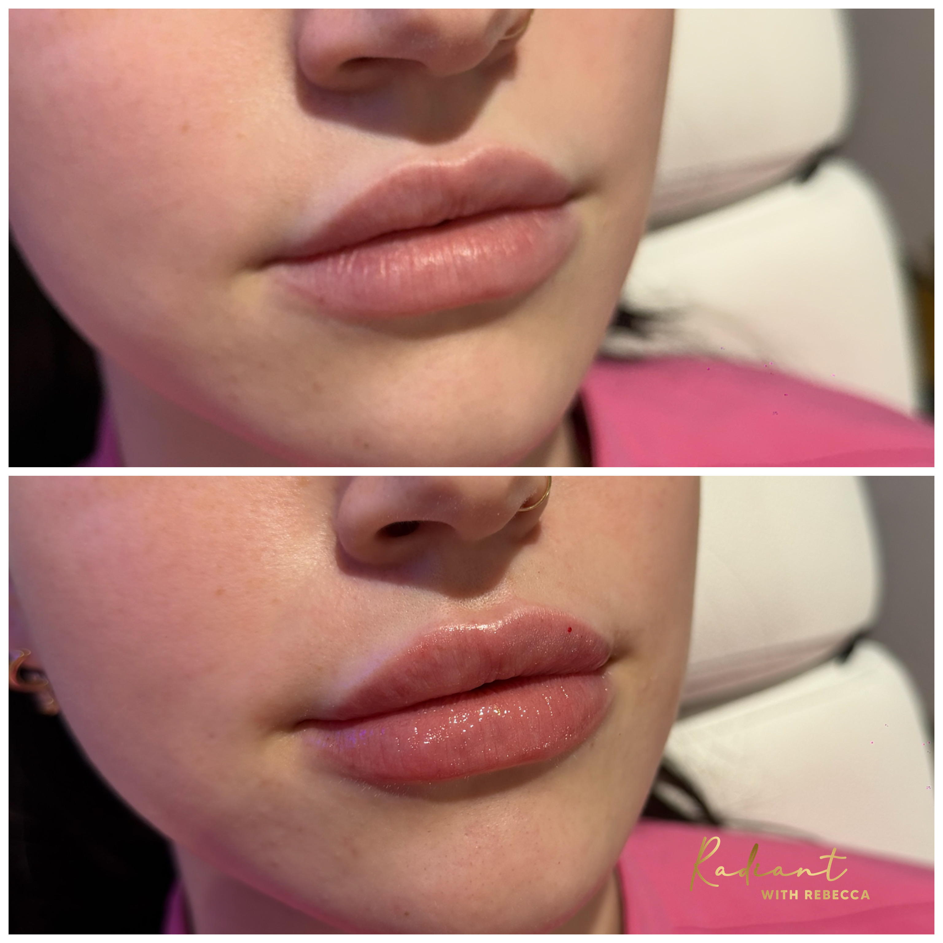Lip Filler result