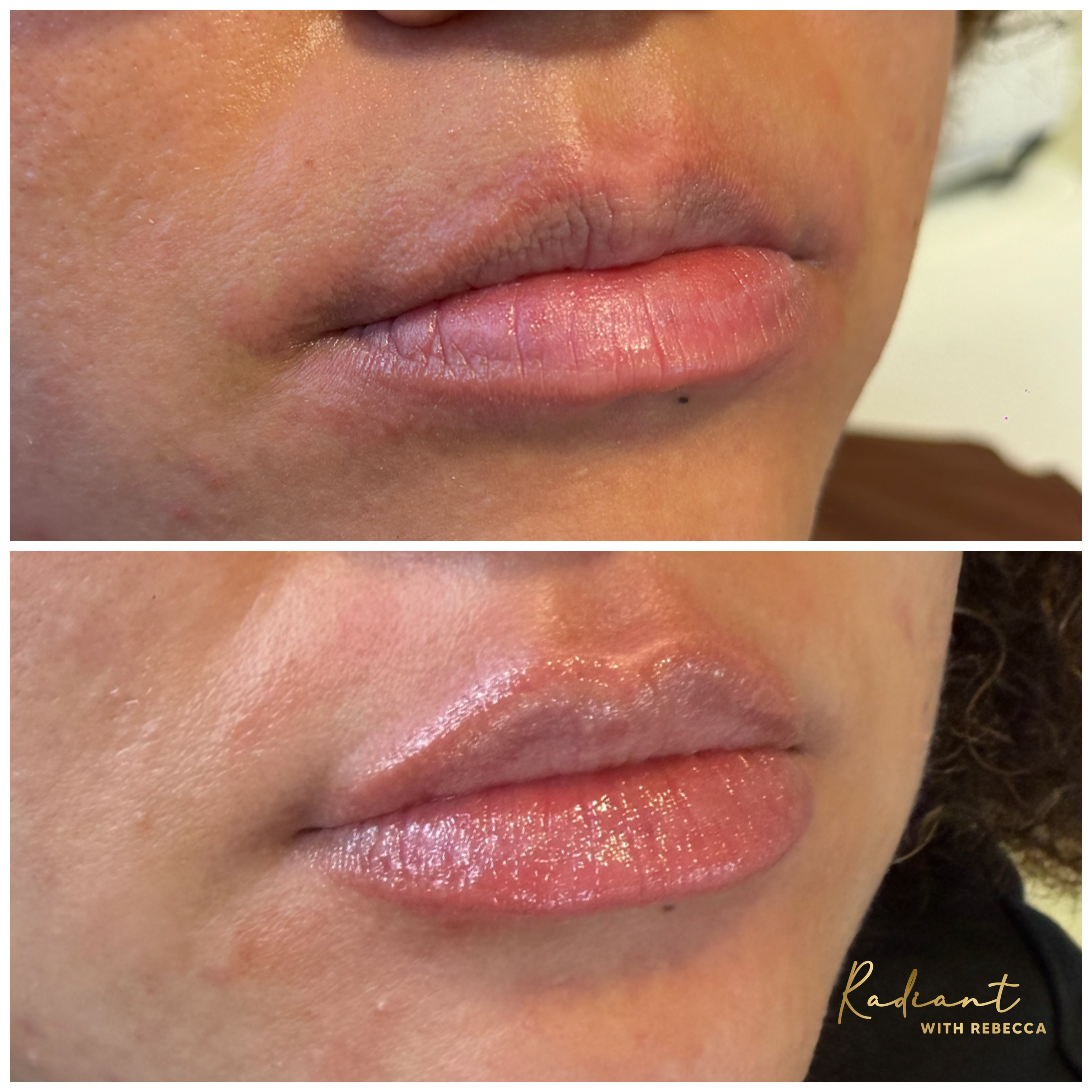 Lip Filler result