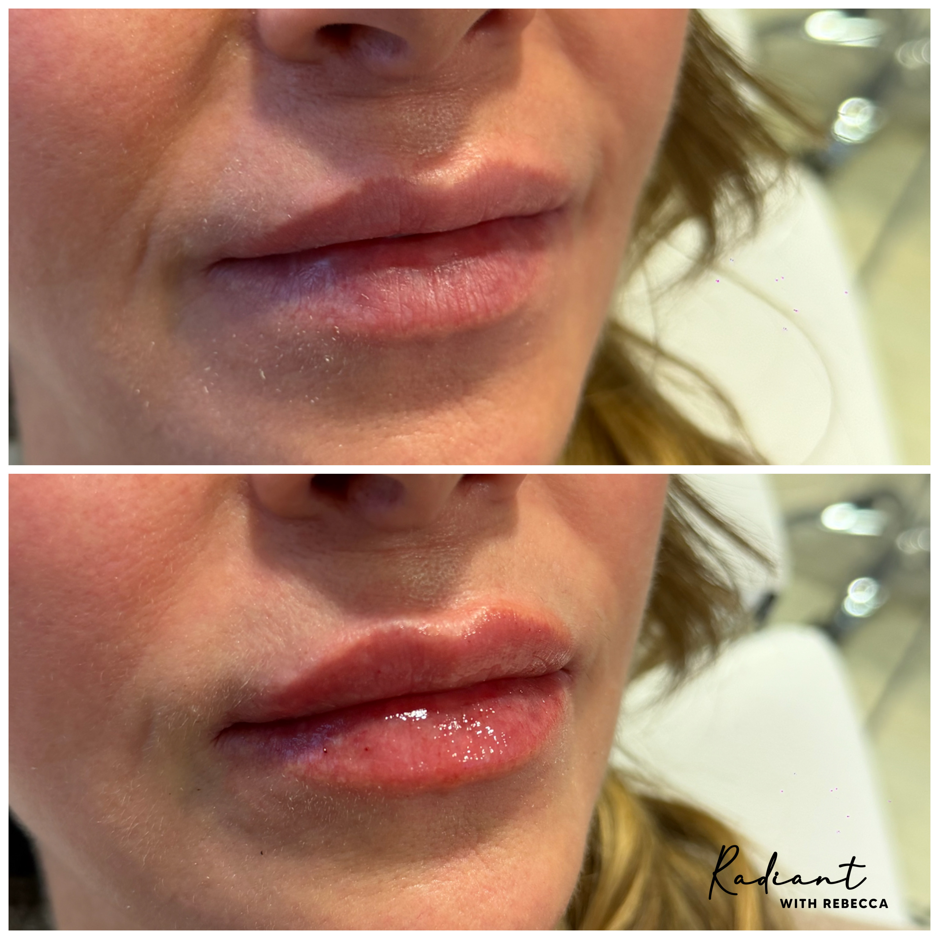 Lip Filler result