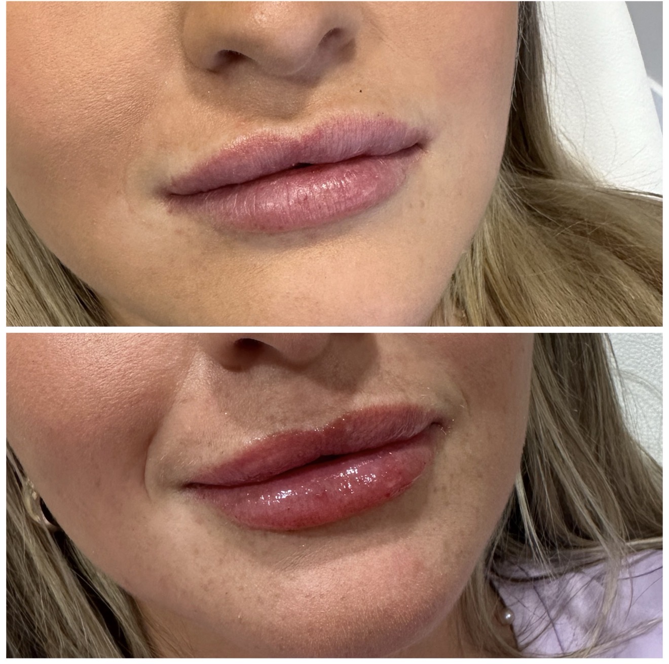 Lip Filler result