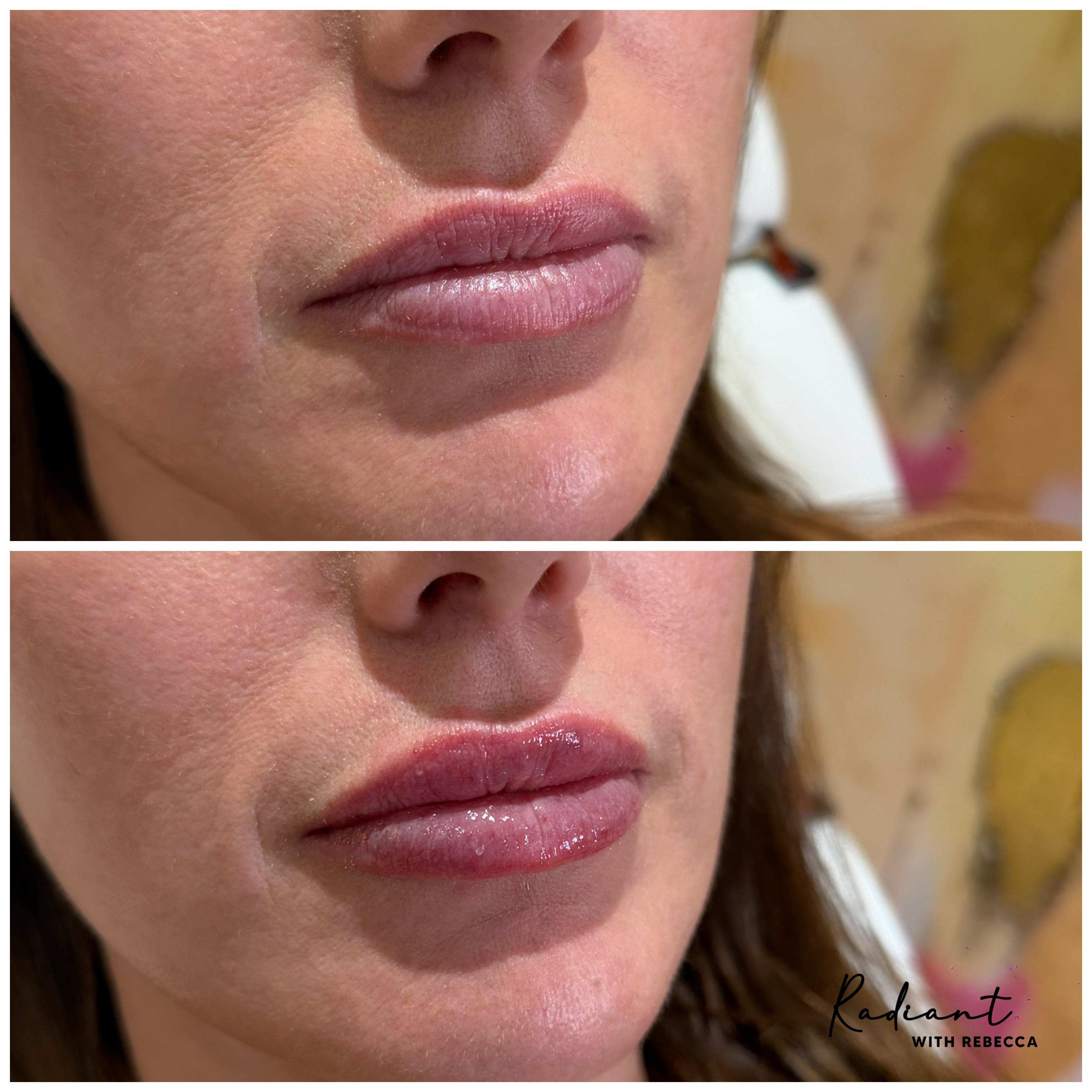 Lip Filler result