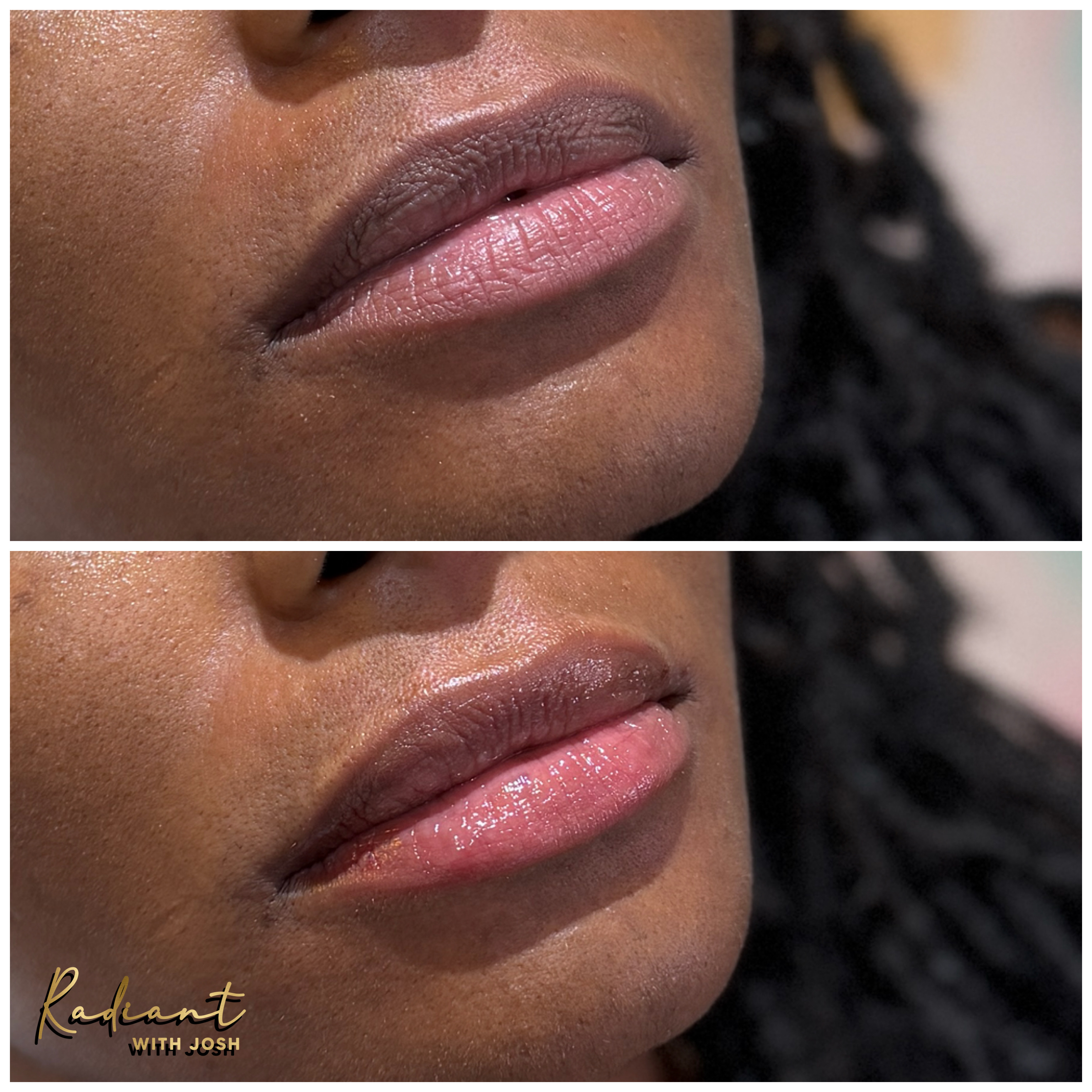 Lip Filler result
