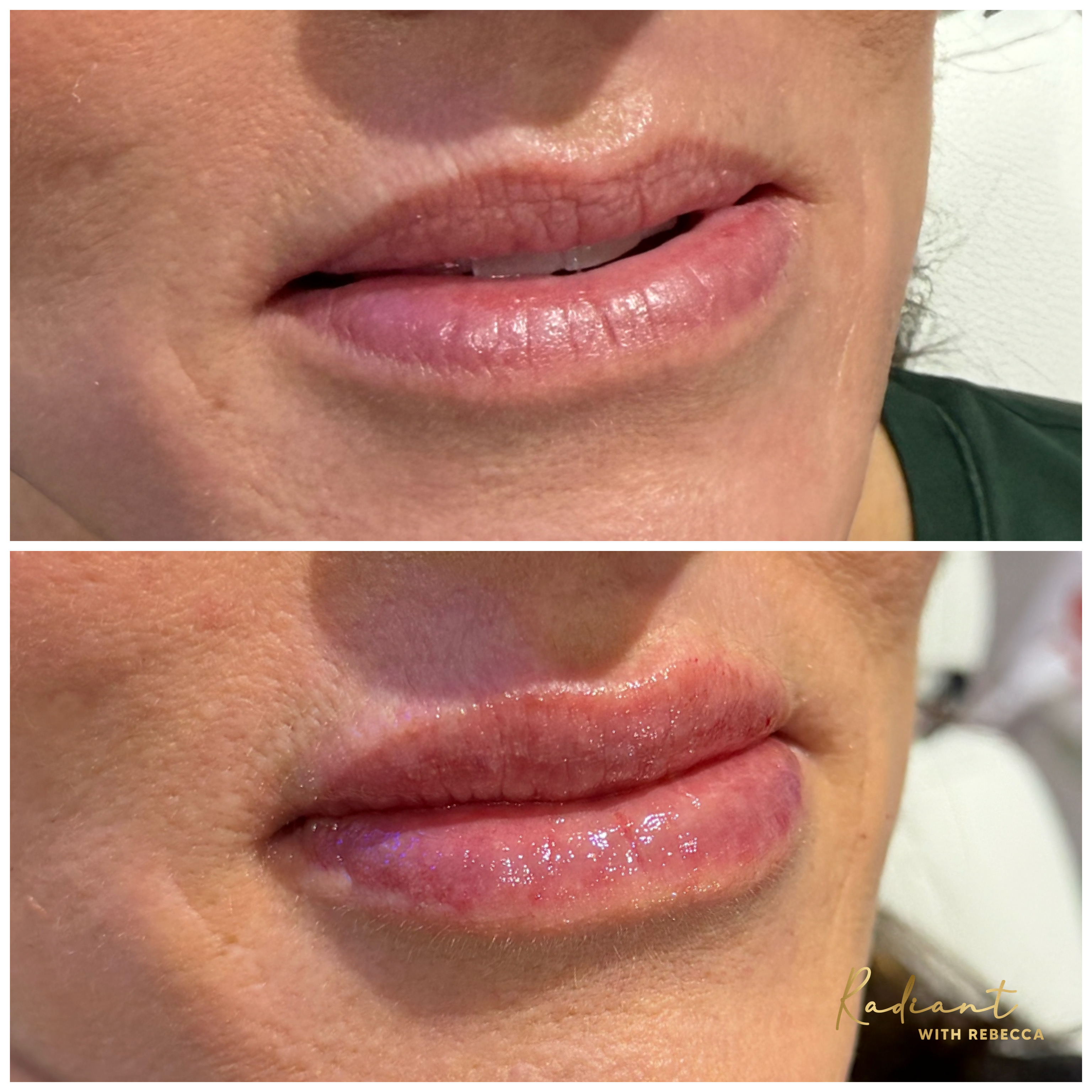 Lip Filler result