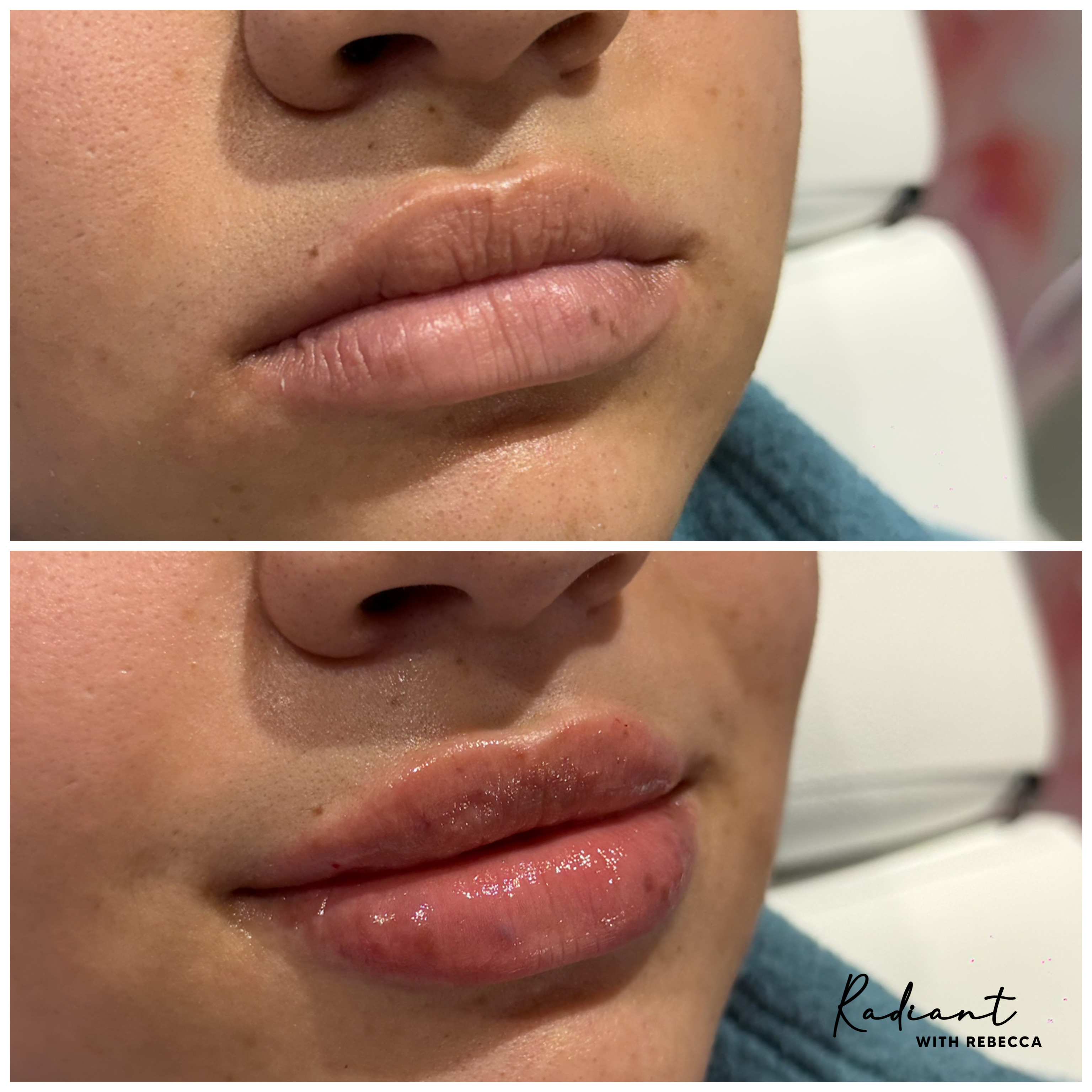 Lip Filler result