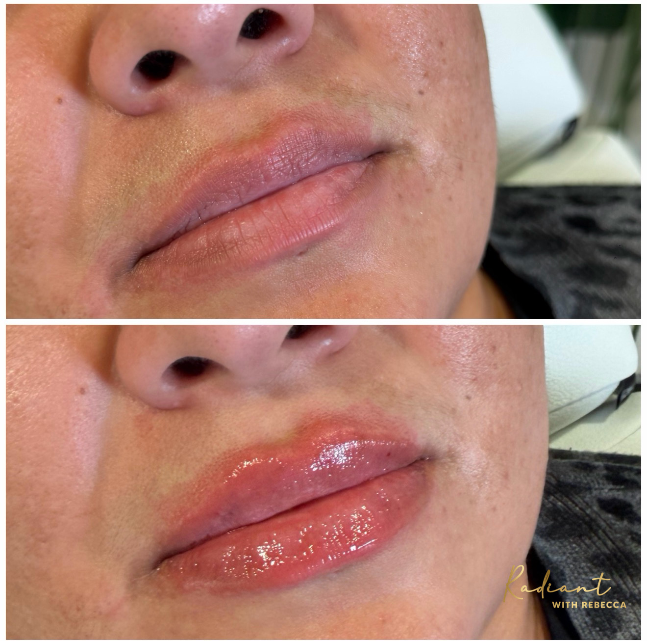 Lip Filler result