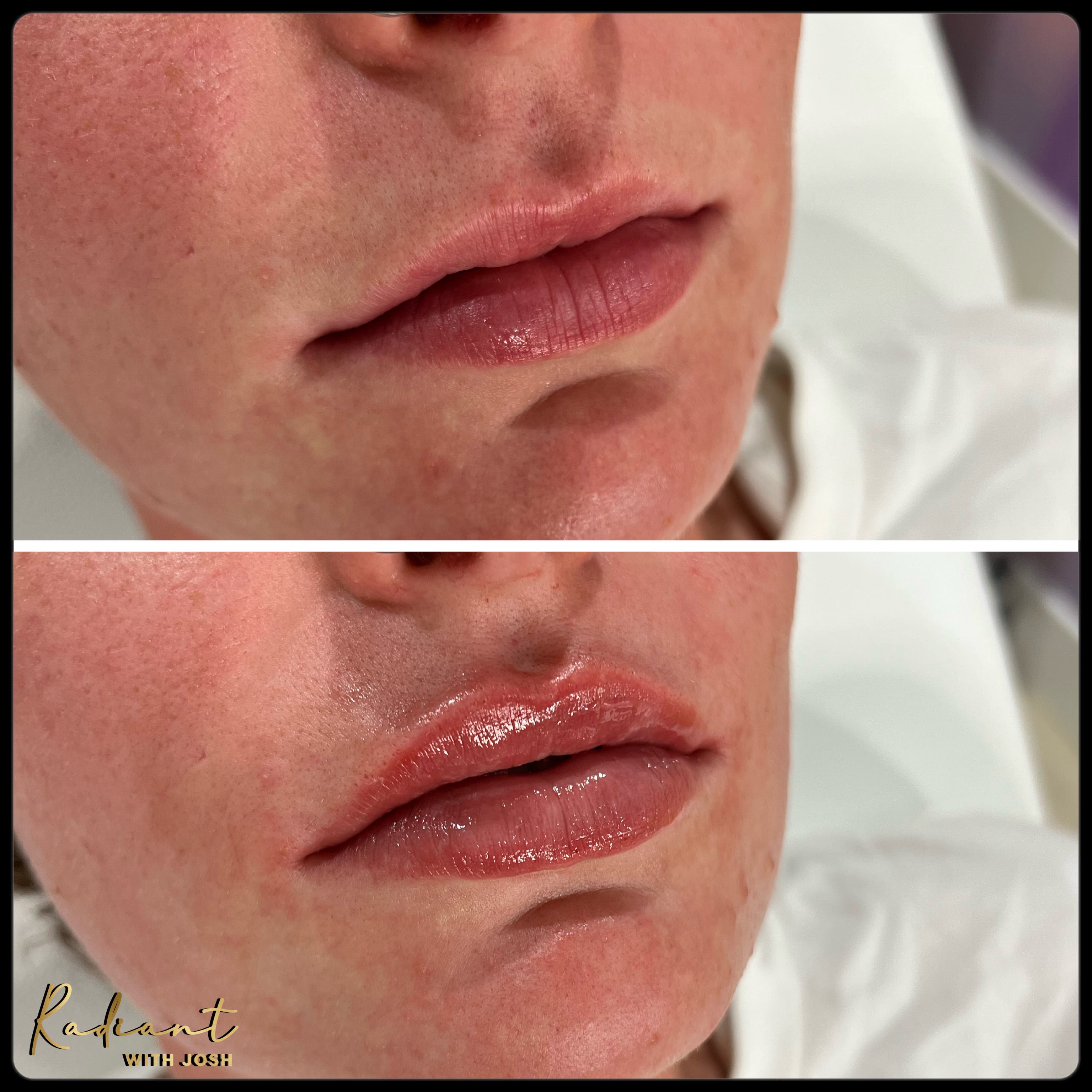 Lip Filler result