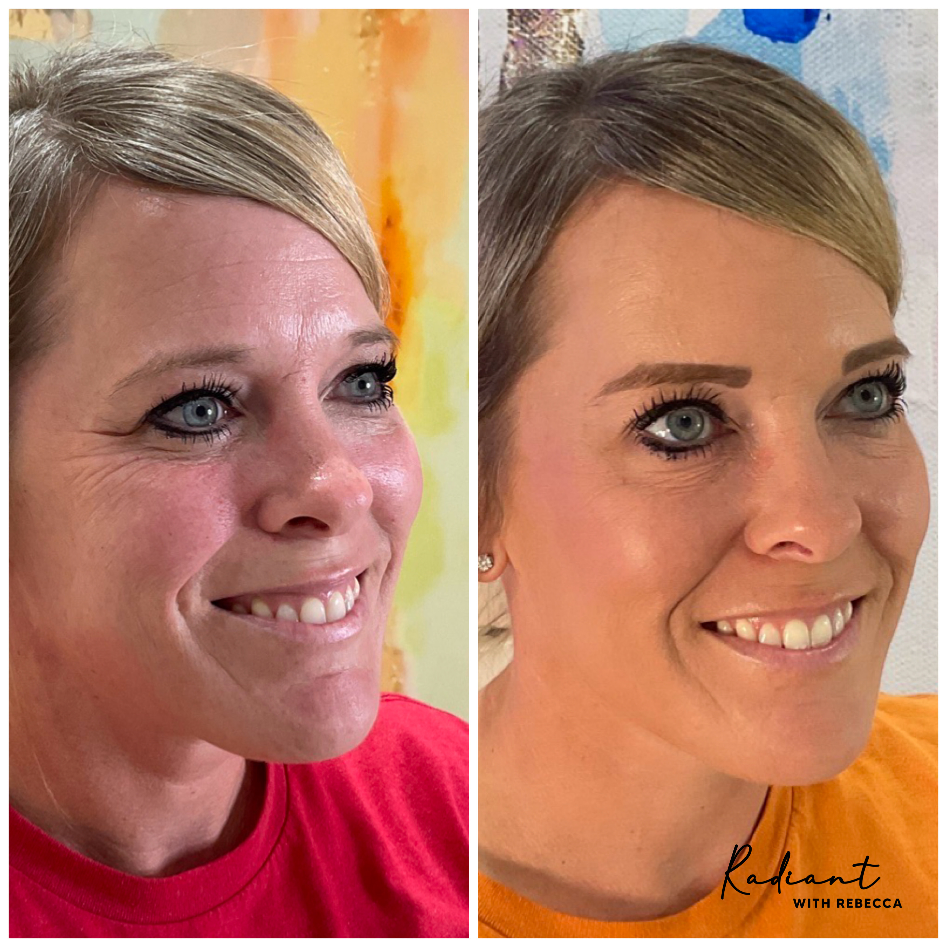 Botox® before and after showing smoothed forehead wrinkles