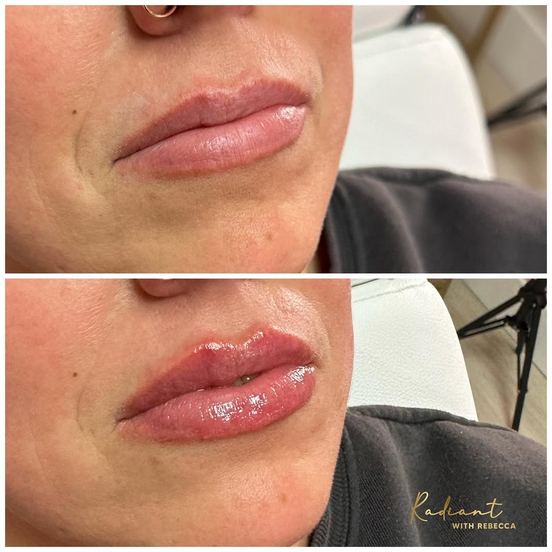 Dermal Filler