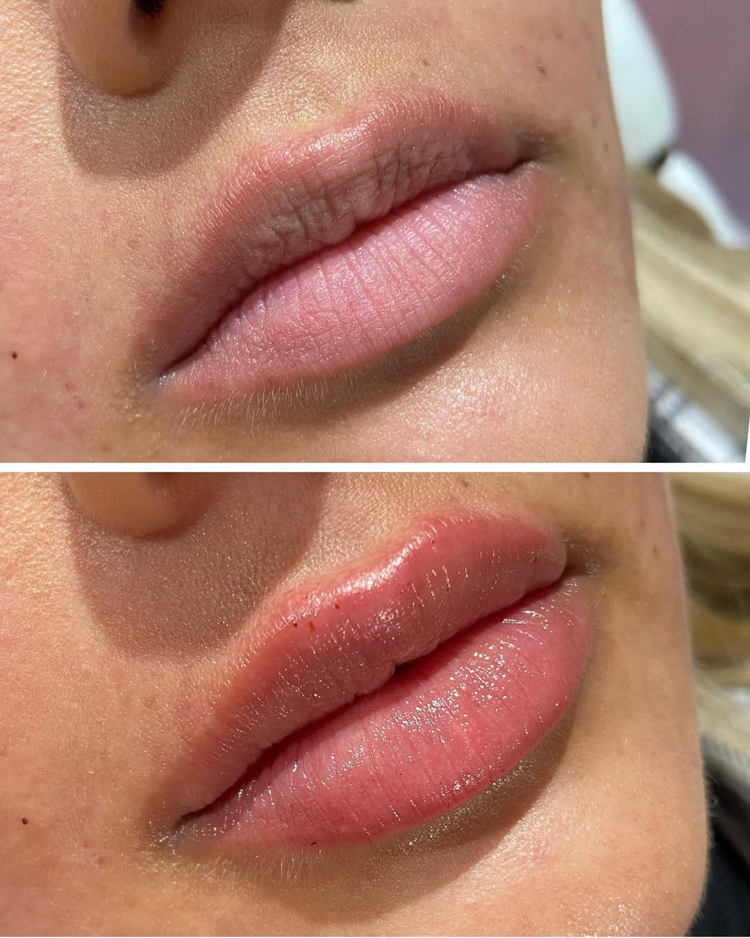 Lip Definition result