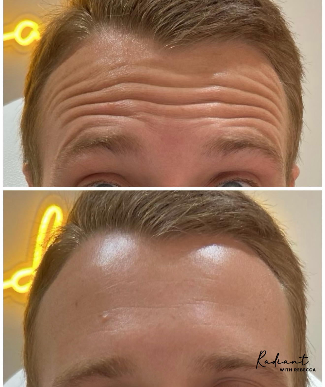 Botox result