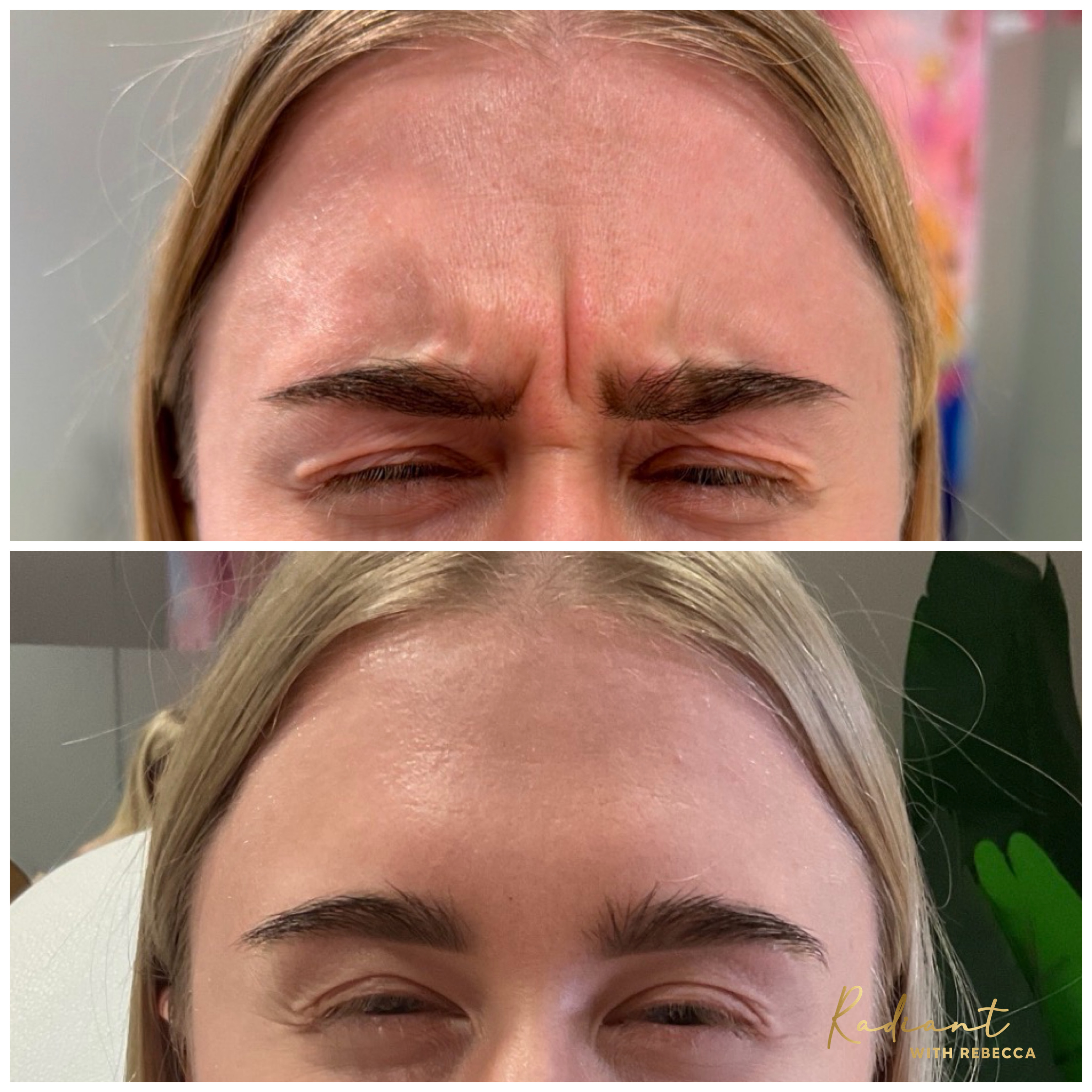 Botox result