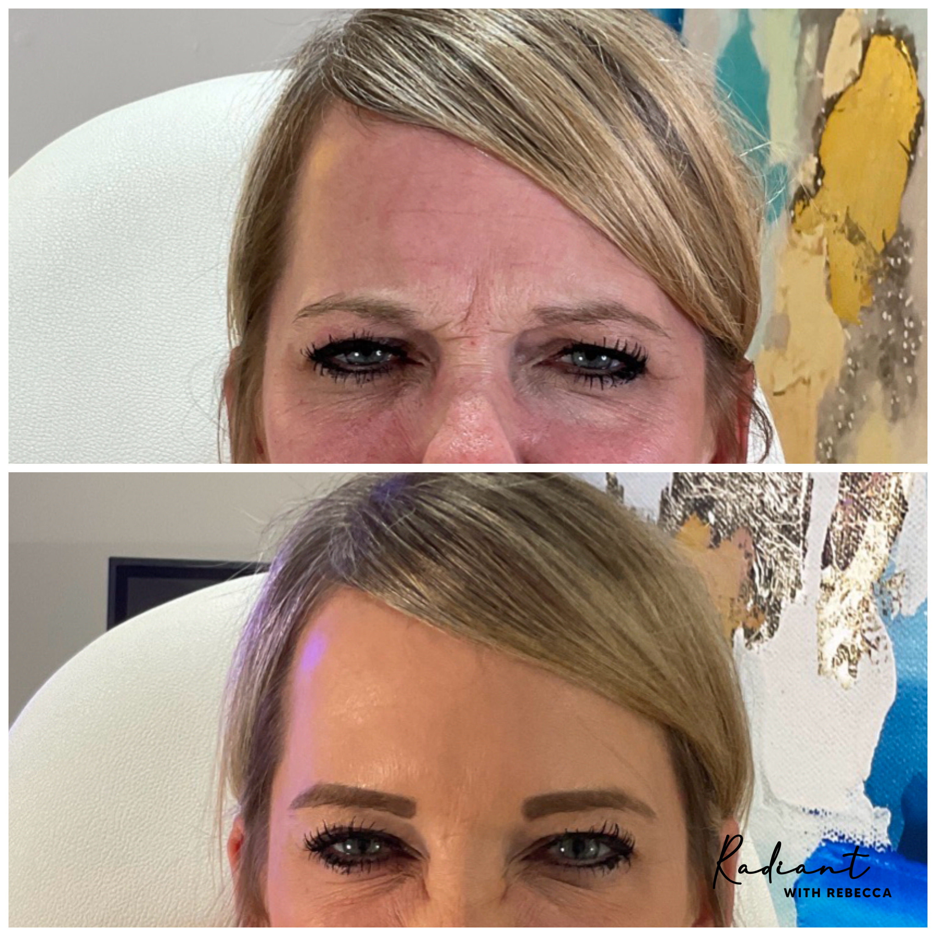 Botox result