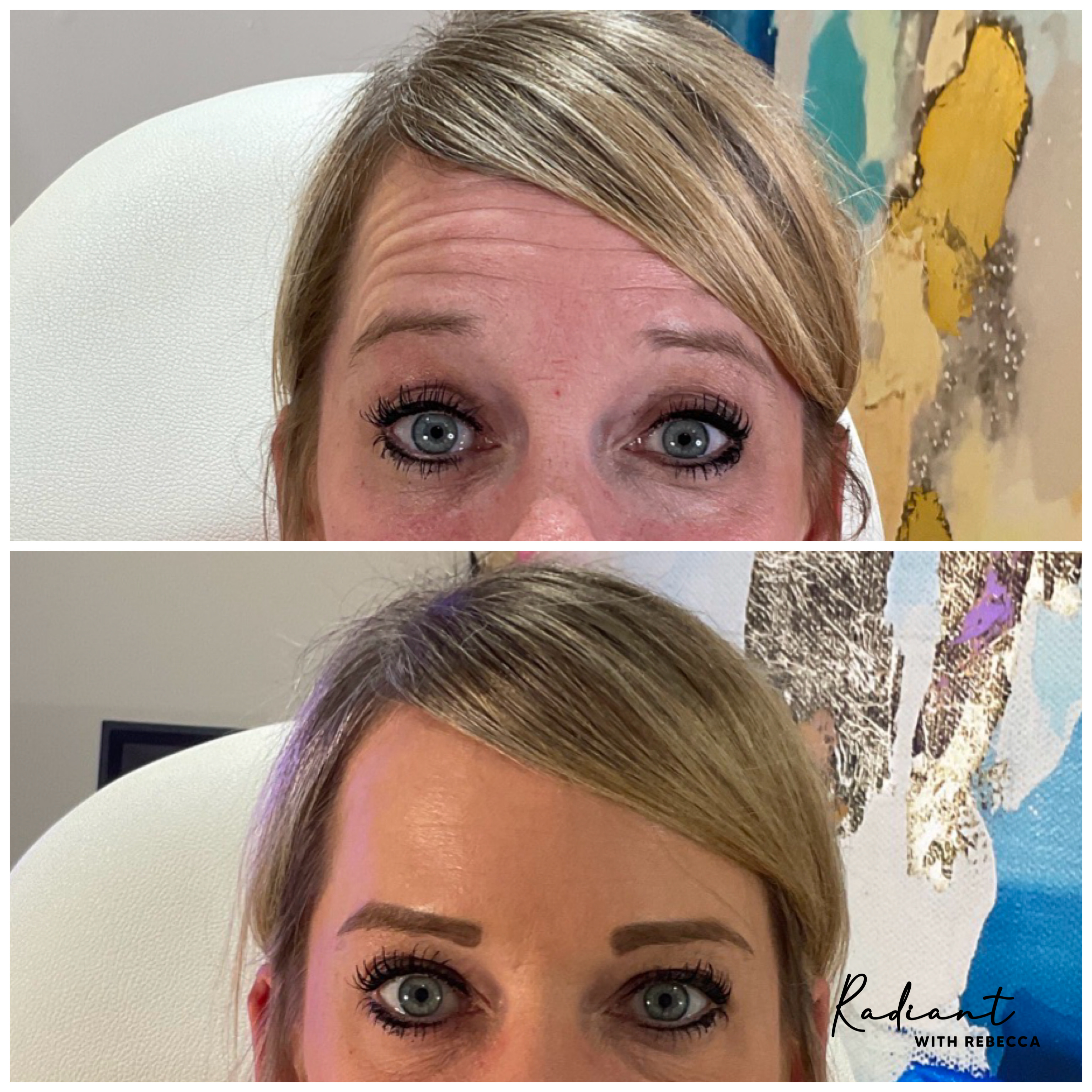 Botox result
