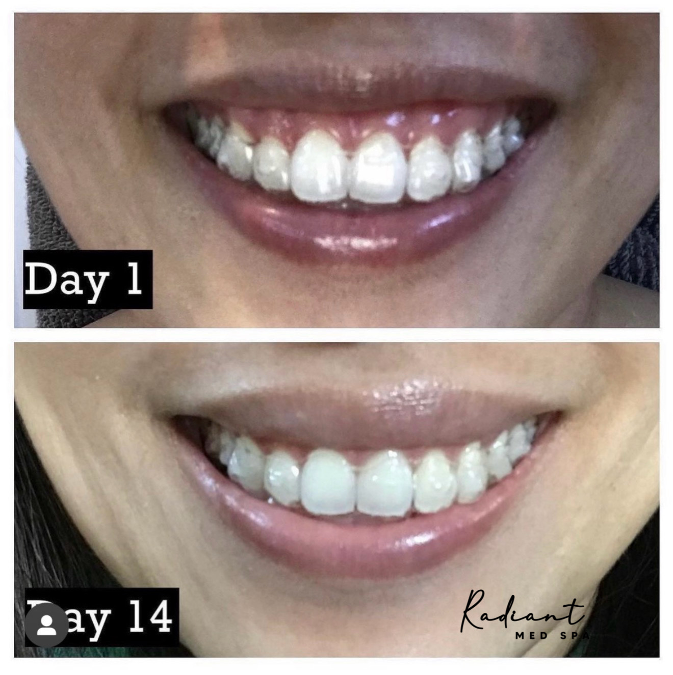 Lip Flip & Lip Filler result