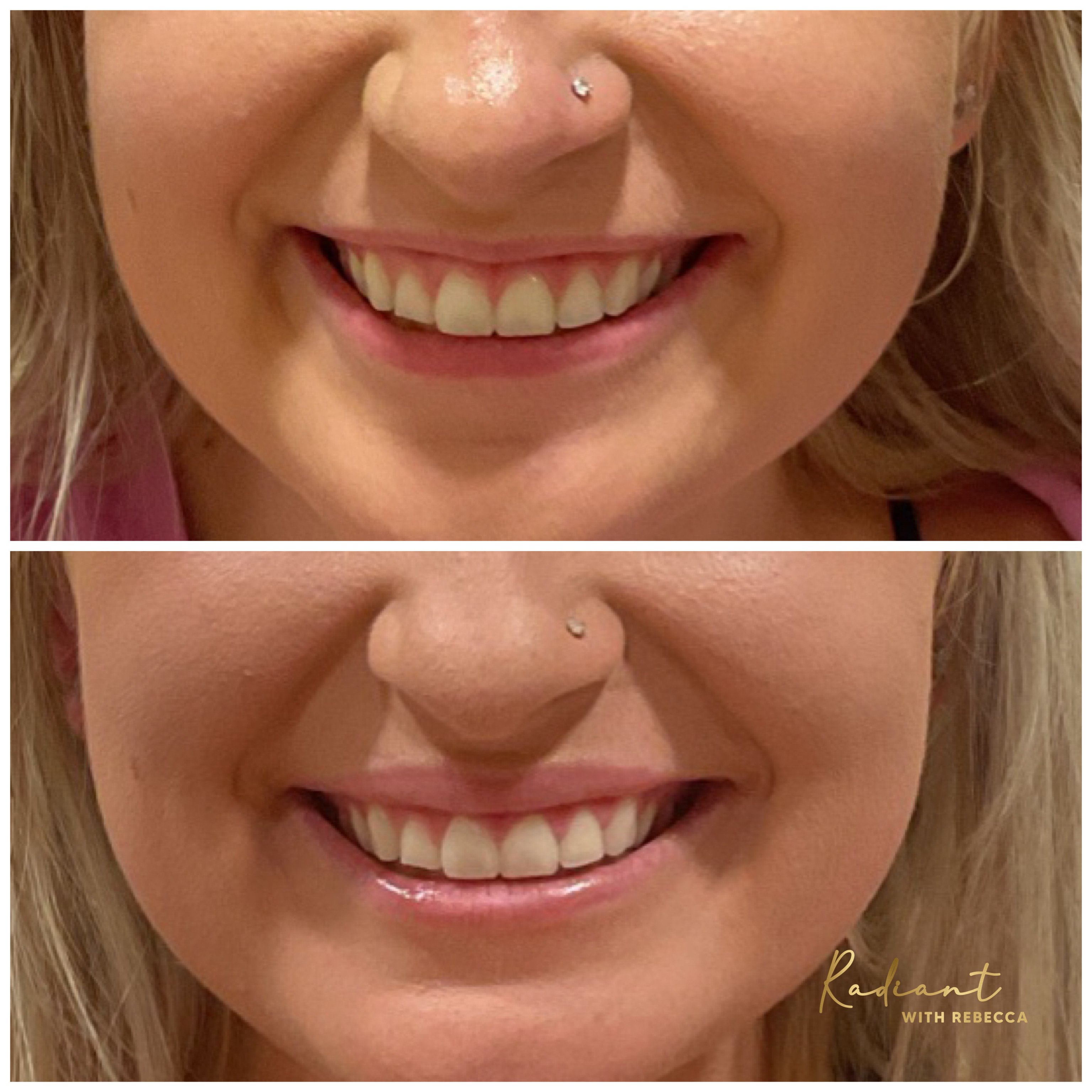 Lip Flip & Lip Filler result