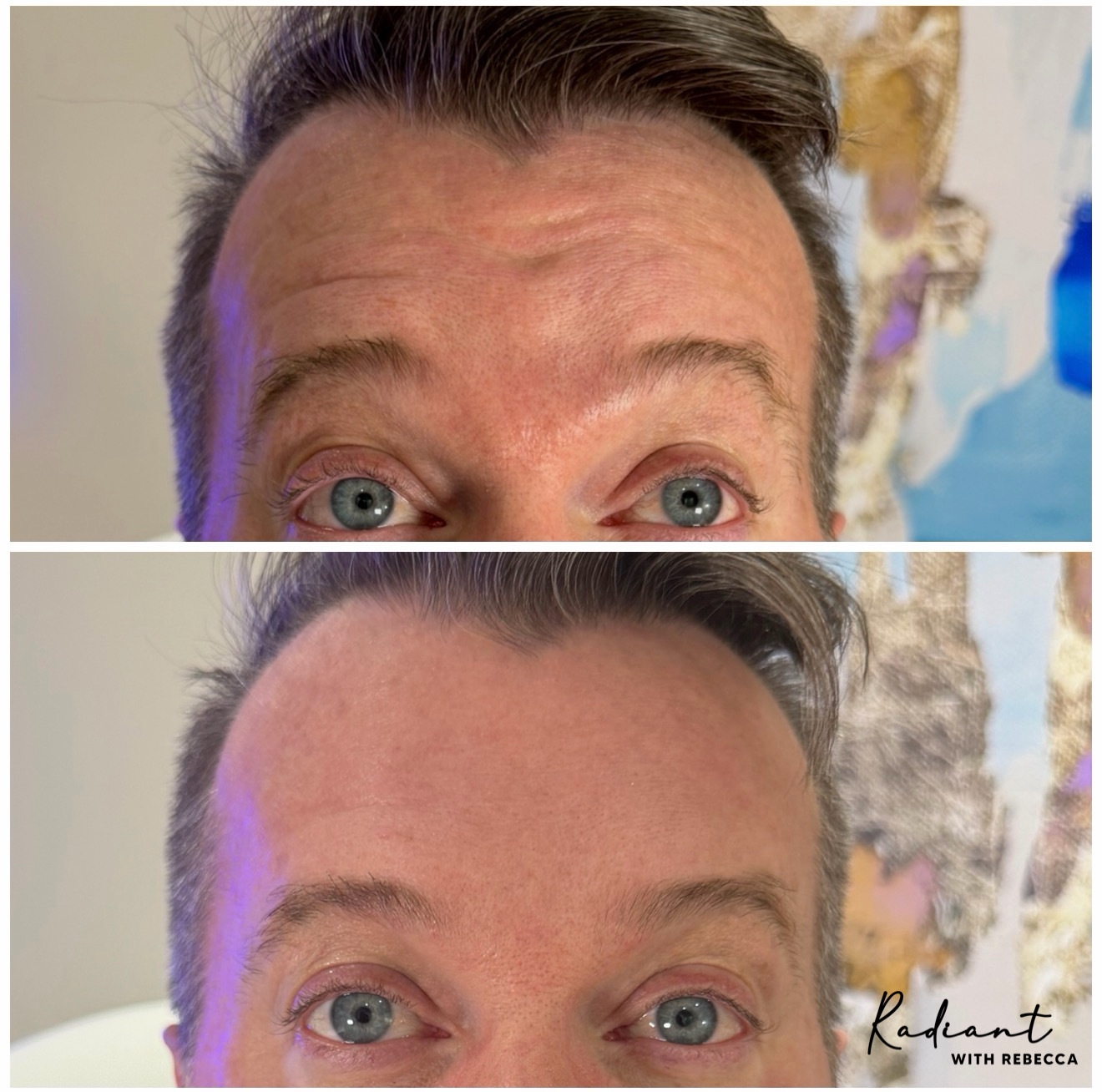 Xeomin result