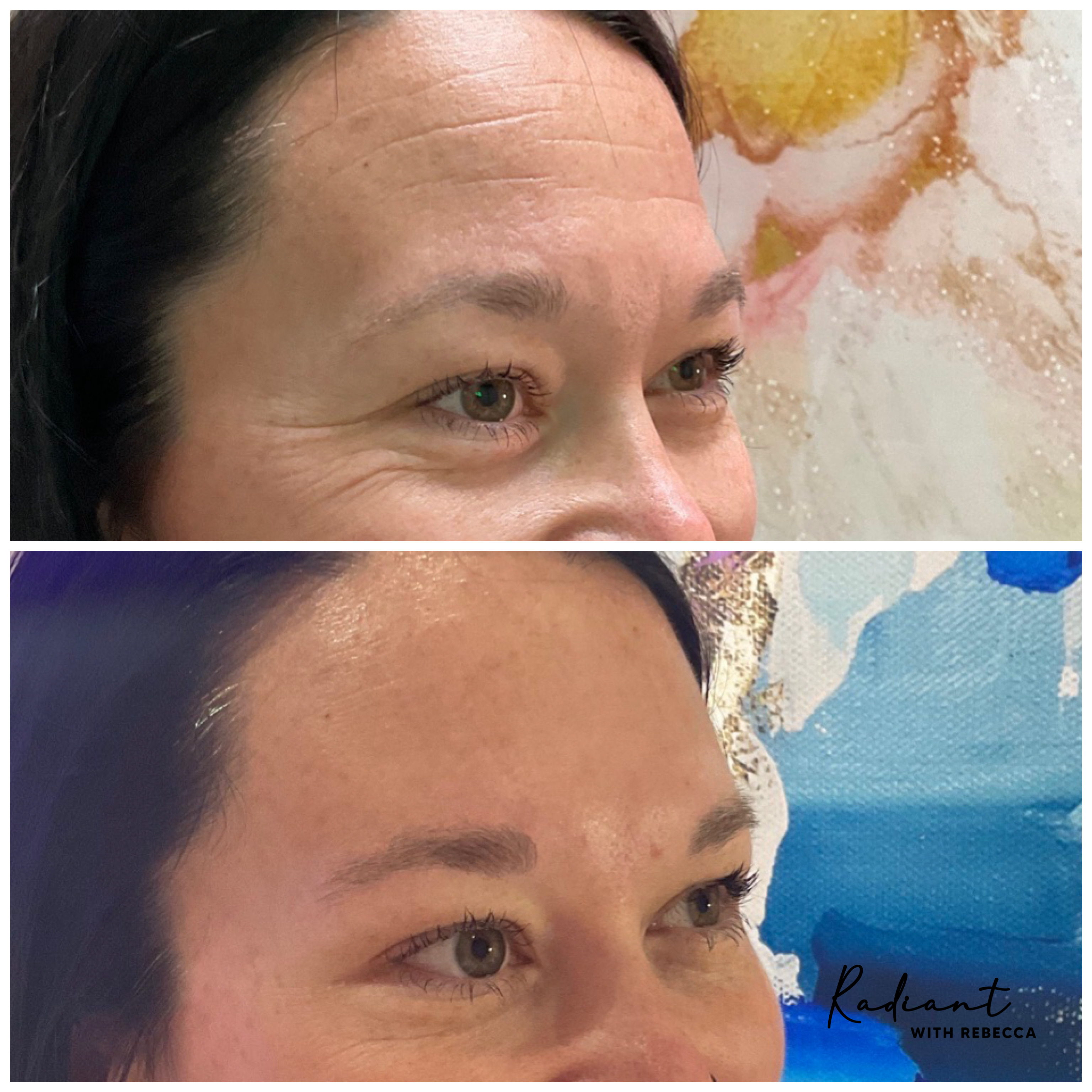 Xeomin result
