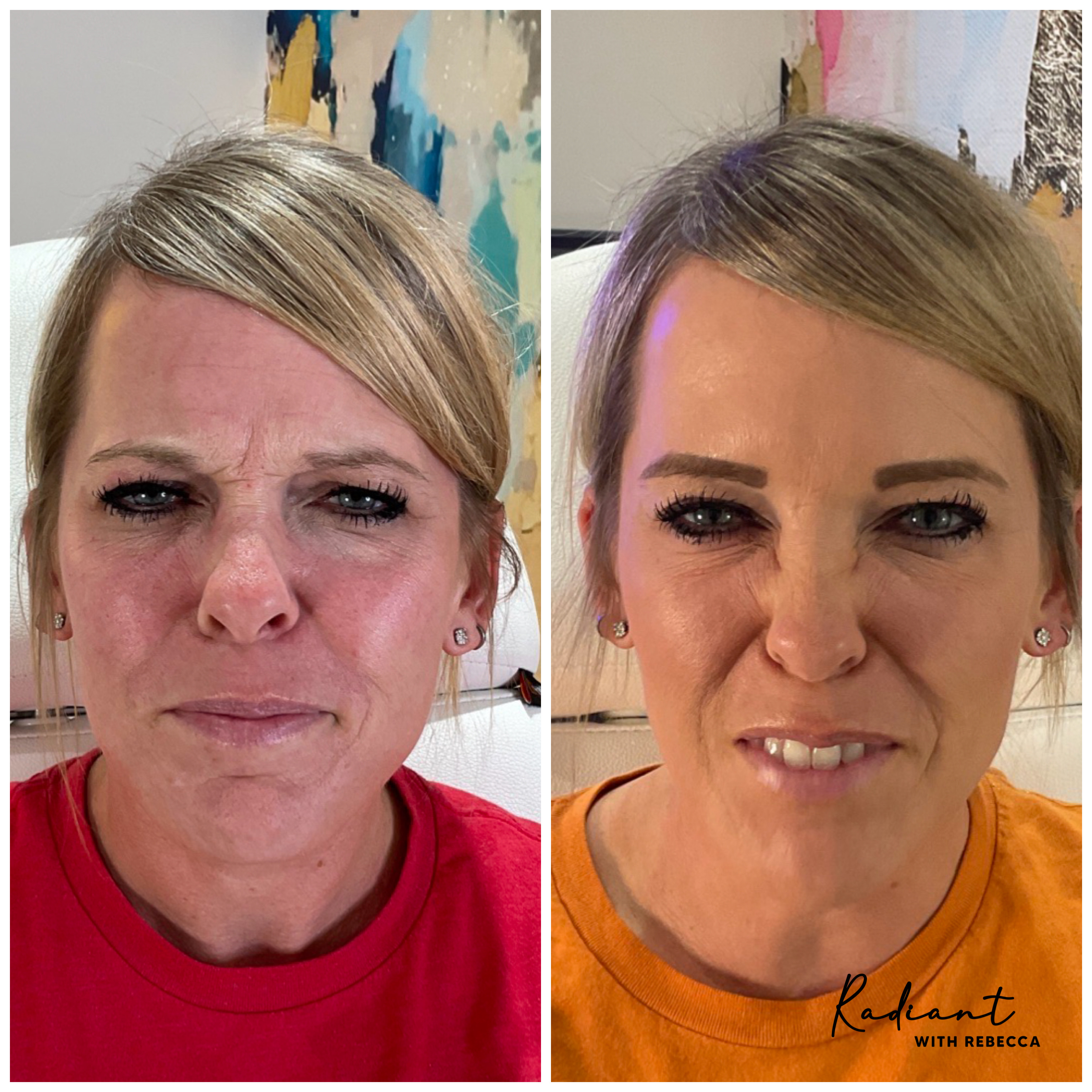 Botox result