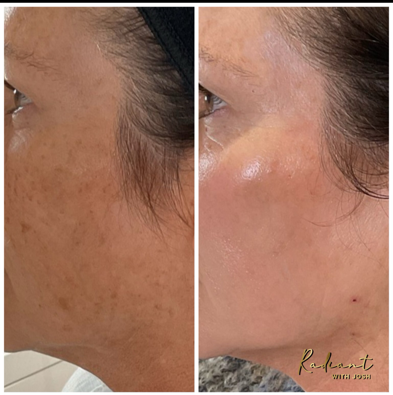 Sciton BBL Hero® & MOXI® Combo result