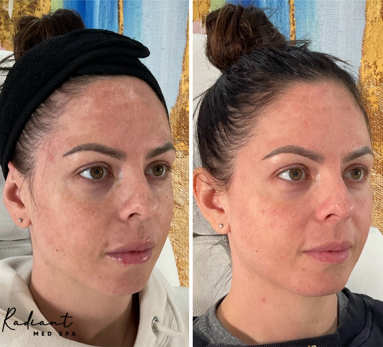 Sciton Moxi Laser result