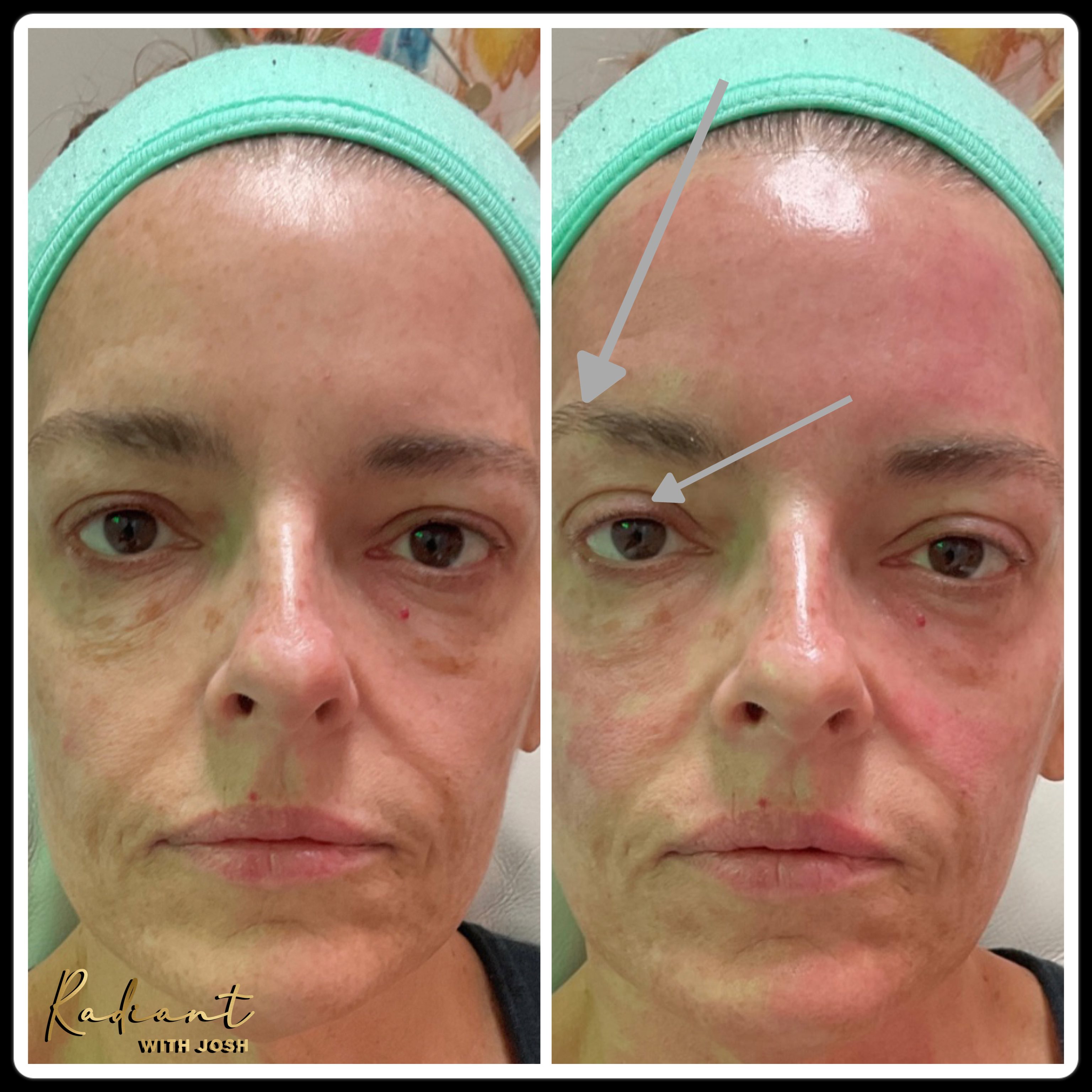 SylfirmX® Treatment result