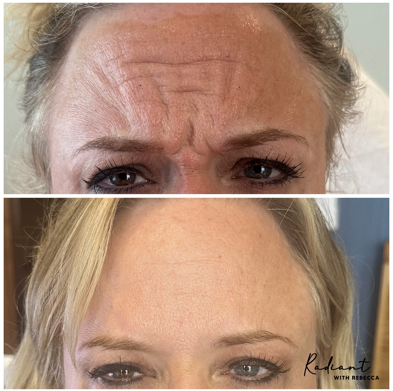 Tox Booster (VI Peel & Xeomin) result