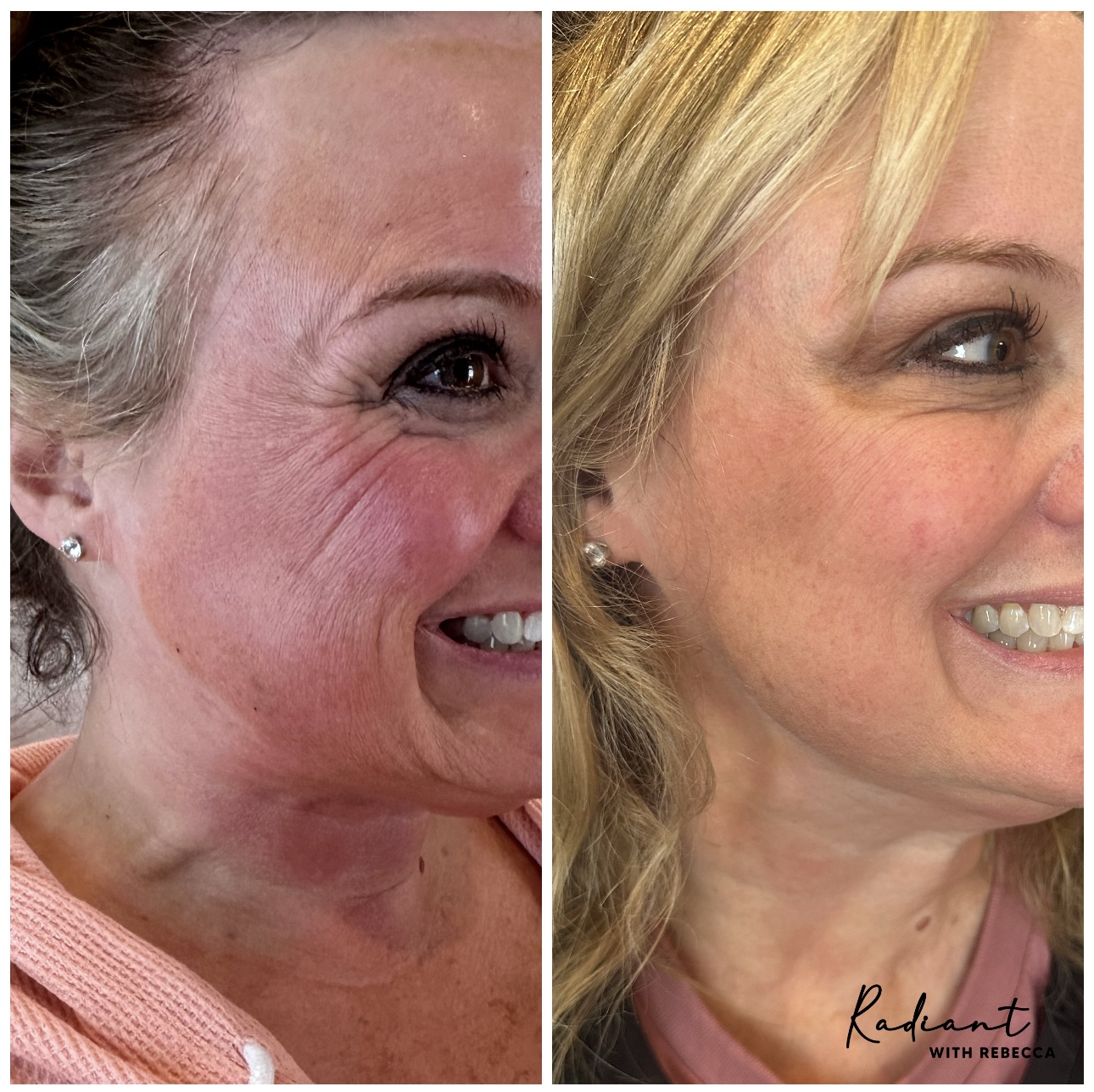 Tox Booster (VI Peel & Xeomin) result