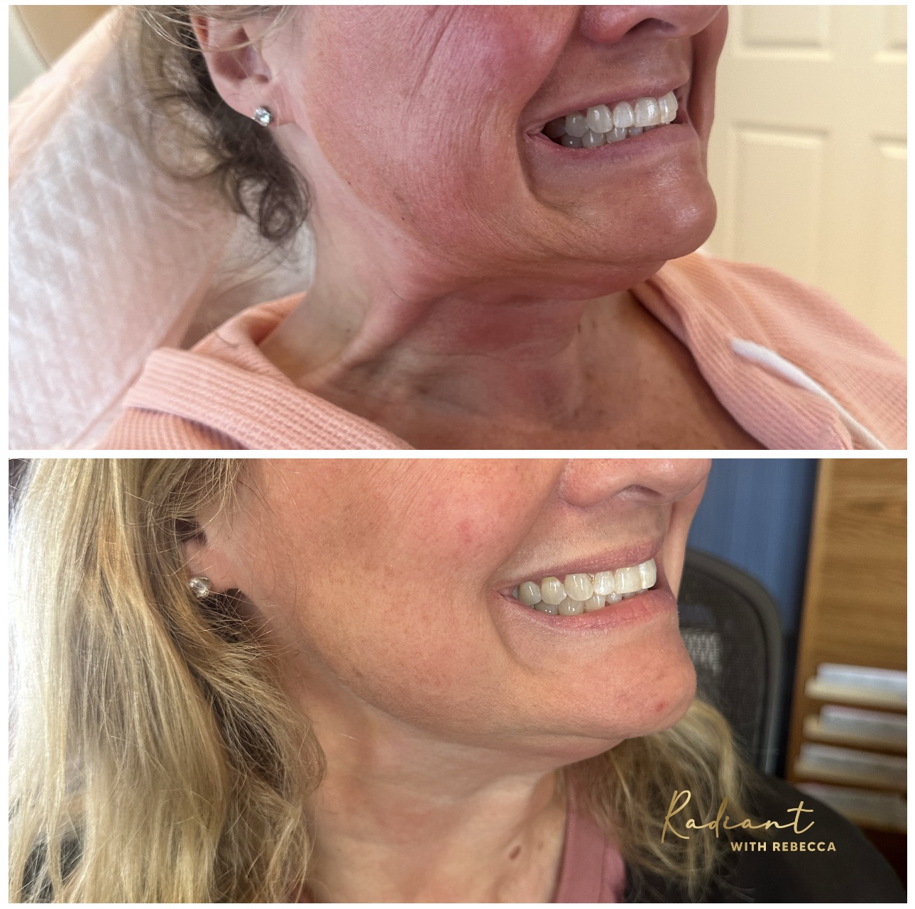 Tox Booster (VI Peel & Xeomin) result
