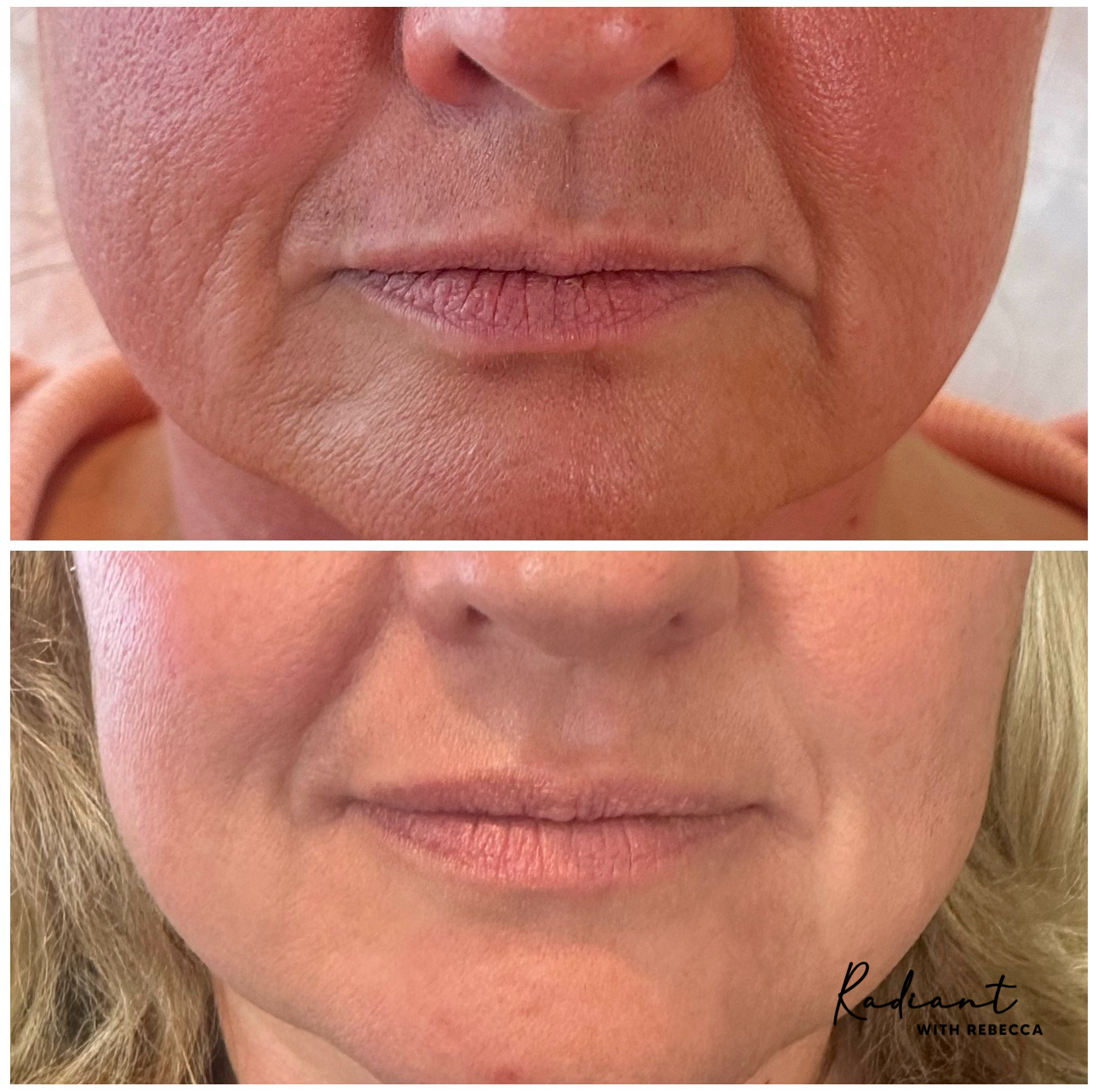 Tox Booster (VI Peel & Xeomin) result